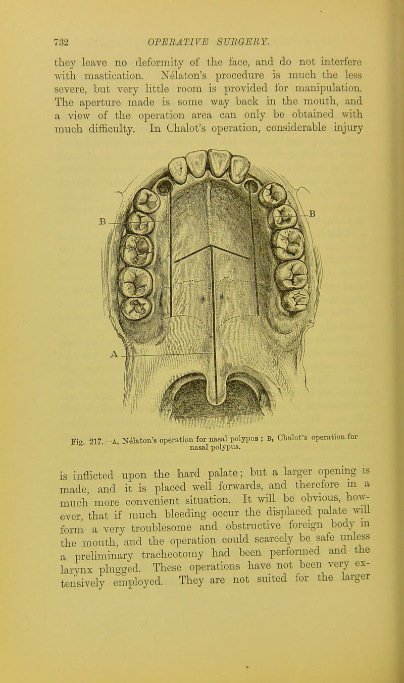 they Leave no deformity of the face, and do not interfere with mastication. Nekton's procedure is much the loss severe, but very little room is provided for manipulation. The aperture made is some way back in the mouth, and a view of the operation area can only be obtained with much difficulty. In Chalot's operation, considerable injury Fi» 217 —A Nelaton's operation for nasal polypus ; B, Chalot's operation °' ' ' nasal polypus. is inflicted upon the hard palate; but a larger opening is made, and it is placed well forwards, and therefore m a much more convenient situation. It will be obvious, how- ever, that if much bleeding occur the displaced palate will form a very troublesome and obstructive foreign body in the mouth, and the operation could scarcely be safe unless a preliminary tracheotomy had been performed and the larynx plugged. These operations have not been very ex- tensively employed. They are not suited for the larger