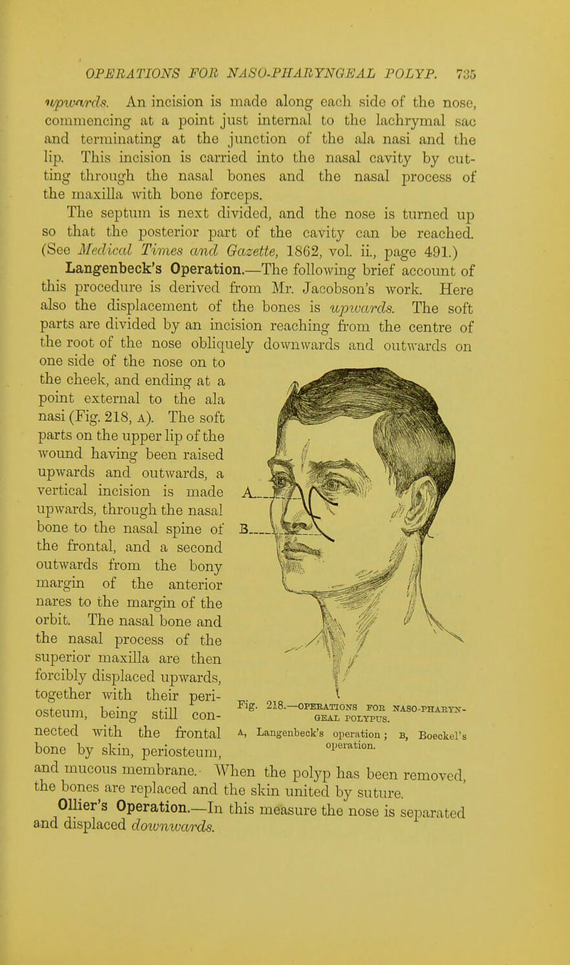 upwards. An incision is made along each side of the nose, commencing at a point just internal to the lachrymal sac and terminating at the junction of the ala nasi and the lip. This incision is carried into the nasal cavity by cut- ting through the nasal bones and the nasal process of the maxilla with bone forceps. The septum is next divided, and the nose is turned up so that the posterior part of the cavity can be reached. (See Medical Times and Gazette, 1862, vol. ii., page 491.) Langenbeck's Operation.—The following brief account of this procedure is derived from Mr. Jacobson's work. Here also the displacement of the bones is upivards. The soft parts are divided by an incision reaching from the centre of the root of the nose obliquely downwards and outwards on one side of the nose on to the cheek, and ending at a point external to the ala nasi (Fig. 218, a). The soft parts on the upper lip of the wound having been raised upwards and outwards, a vertical incision is made upwards, through the nasal bone to the nasal spine of the frontal, and a second outwards from the bony margin of the anterior nares to the margin of the orbit. The nasal bone and the nasal process of the superior maxilla are then forcibly displaced upwards, together with their peri- osteum, being still con- nected with the frontal bone by skin, periosteum, and mucous membrane. When the polyp has been removed the bones are replaced and the skin united by suture. Ollier's Operation.—In this measure the nose is separated and displaced downwards. A,. Fig 218.—OPERATIONS FOE NASO-PHAKYN- GEAL POLYPUS. Langenbeck's operation; b, Boeckel's operation.