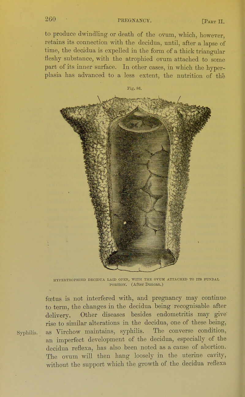 to produce dwindling or death of the ovum, which, however, retains its connection with the decidua, until, after a lapse of time, the decidua is expelled in the form of a thick triangular fleshy substance, with the atrophied ovum attached to some part of its inner surface. In other cases, in which the hyper- plasia kas advanced to a less extent, tke nutrition of tk'e Fig. I HYI'ERTBOPHIED DECIDUA LAID OPEN, WITH THE OVUM ATTACHED TO ITS FUXDAL portion. (After Duncan.) foetus is not interfered witk, and pregnancy may continue to term, tke changes in the decidua being recognisable after delivery. Other diseases besides endometritis may give rise to similar alterations in the decidua, one of these being, Syphilis, as Virchow maintains, syphilis. The converse condition, an imperfect development of the decidua, especially of the decidua reflexa, has also been noted as a ctrnse of abortion. The ovum will then hang loosely in the uterine cavity, without the support which the growth of the decidua reflexa