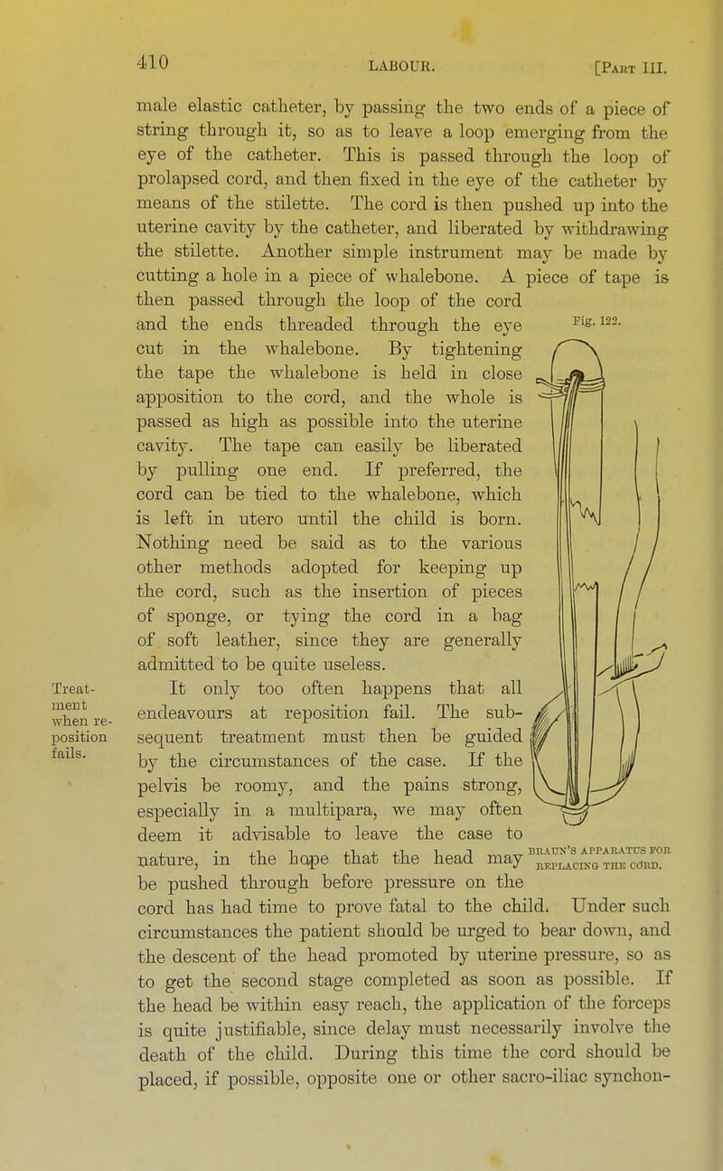 Treat- ment when re- position fails. male elastic catheter, by passing the two ends of a piece of string through, it, so as to leave a loop emerging from the eye of the catheter. This is passed through the loop of prolapsed cord, and then fixed in the eye of the catheter by means of the stilette. The cord is then pushed up into the uterine cavity by the catheter, and liberated by withdrawing the stilette. Another simple instrument may be made by cutting a hole in a piece of whalebone. A piece of tape is then passed through the loop of the cord and the ends threaded through the eye Fig-m- cut in the whalebone. By tightening the tape the whalebone is held in close apposition to the cord, and the whole is passed as high as possible into the uterine cavity. The tape can easily be liberated by pulling one end. If preferred, the cord can be tied to the whalebone, which is left in utero until the child is born. Nothing need be said as to the various other methods adopted for keeping up the cord, such as the insertion of pieces of sponge, or tying the cord in a bag of soft leather, since they are generally admitted to be quite useless. It only too often happens that all endeavours at reposition fail. The sub- sequent treatment must then be guided by the circumstances of the case. If the pelvis be roomy, and the pains strong, especially in a multipara, we may often deem it advisable to leave the case to , i i , T ,1 l n „ BRAUX'S APPARATUS FOR nature, in the hope that the head may BKPLACING TI1I: (01:D. be pushed through before pressure on the cord has had time to prove fatal to the childi Under such circumstances the patient should be urged to bear down, and the descent of the head promoted by uterine pressure, so as to get the second stage completed as soon as possible. If the head be within easy reach, the application of the forceps is quite justifiable, since delay must necessarily involve the death of the child. During this time the cord should be placed, if possible, opposite one or other sacro-iliac synchon- %