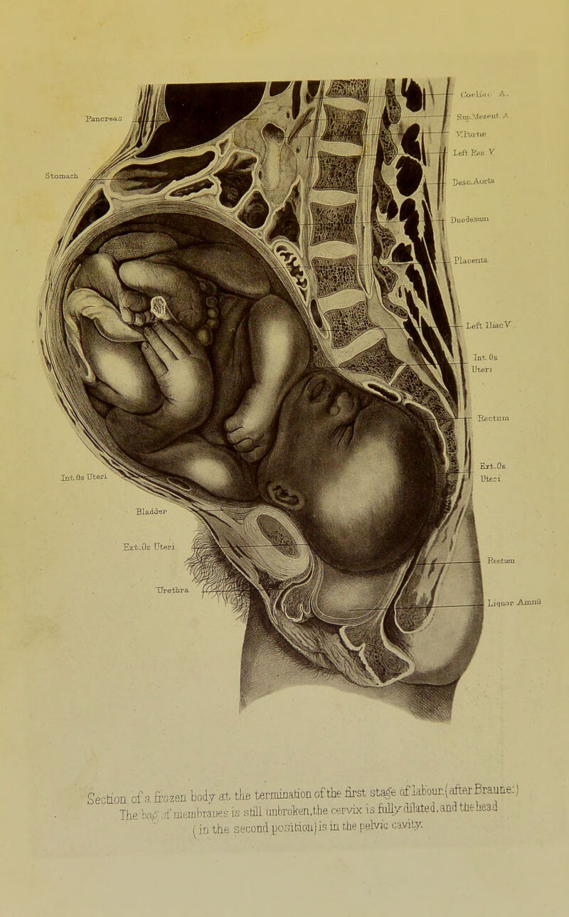 Se-tioQ oi\. ar^zen body at the tern±:alion of the first sta^e cfkbour.{^^^^ The hii^: jf membraues is stfll imhrolfen.the rervbc is M/dilated, and the head (in the secoBiiponiriou)isiu t.he phIvi'i; .;)vi!y.