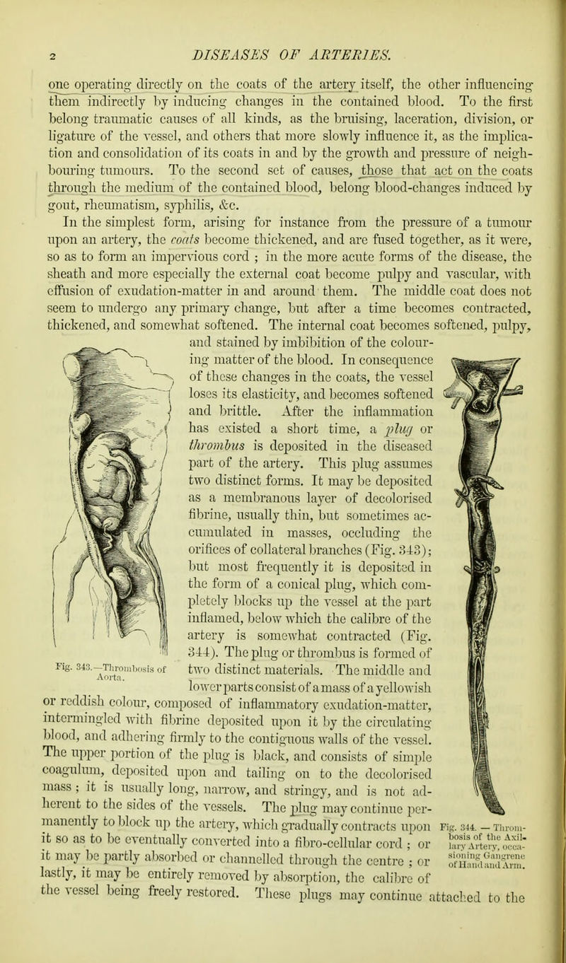 one operating directly on the coats of the artery itself, the other influencing- them indirectly by inducing changes in the contained blood. To the first belong traumatic causes of all kinds, as the bruising, laceration, division, or ligature of the vessel, and others that more slowly influence it, as the implica- tion and consolidation of its coats in and by the growth and pressure of neigh- bouring tumours. To the second set of causes, Jhose that act on the coats through the medium of the contained blood, belong blood-changes induced by gout, rheumatism, syphilis, &c. In the simplest form, arising for instance from the pressure of a tumour upon an artery, the coats become thickened, and are fused together, as it were, so as to form an impervious cord ; in the more acute forms of the disease, the sheath and more especially the external coat become pulpy and vasculai*, with effusion of exudation-matter in and around them. The middle coat does not seem to undergo any primary change, but after a time becomes contracted, thickened, and somewhat softened. The internal coat becomes softened, pulpy, and stained by imbibition of the colour- ing matter of the blood. In consequence of these changes in the coats, the vessel loses its elasticity, and becomes softened and brittle. After the inflammation has existed a short time, a plug or thrombus is deposited in the diseased part of the artery. This plug assumes two distinct forms. It may be deposited as a membranous layer of decolorised fibrine, usually thin, but sometimes ac- cumulated in masses, occluding the orifices of collateral branches (Fig. 343); but most frequently it is deposited in the form of a conical plug, which com- pletely blocks up the vessel at the part inflamed, below which the calibre of the artery is somewhat contracted (Fig. 344). The plug or thrombus is formed of two distinct materials. The middle and lowerparts consist of amass of a yellowish or reddish colour, composed of inflammatory exudation-matter, intermingled with fibrine deposited upon it by the circulating blood, and adhering firmly to the contiguous walls of the vessel. The upper portion of the plug is black, and consists of simple coaguhun,^ deposited upon and tailing on to the decolorised mass ; it is usually long, narrow, and stringy, and is not ad- herent to the sides of the vessels. The plug may continue per- manently to block up the artery, which gradually contracts upon it so as to be eventually converted into a fibro-cellular cord ; or it may be partly absorbed or channelled through the centre ; or lastly, it may be entirely removed by absorption, the calibre of the vessel being freely restored. These plugs may continue attached to the Fig. 343.—Thrombosis of Aorta. fig. 3-14. — Throm- bosis of the Axil, lary Artery, occa- sioning Gangrene ofHandandArm.