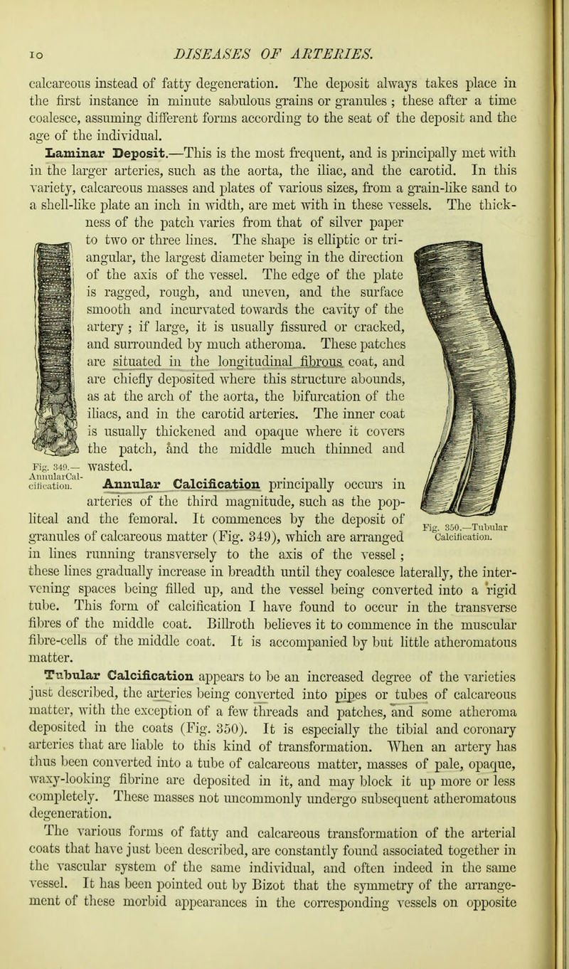 calcareous instead of fatty degeneration. The deposit always takes place in the first instance in minute sabulous grains or granules ; these after a time coalesce, assuming different forms according to the seat of the deposit and the age of the individual. Laminar in the larger Deposit.—This is the most frequent, and is principally met with arteries, such as the aorta, the iliac, and the carotid. In this variety, calcareous masses and plates of various sizes, from a grain-like sand to a shell-like plate an inch in width, are met with in these vessels. The thick- ness of the patch varies from that of silver paper to two or three lines. The shape is elliptic or tri- angular, the largest diameter being in the direction of the axis of the vessel. The edge of the plate is ragged, rough, and uneven, and the surface smooth and incurvated towards the cavity of the artery; if large, it is usually fissured or cracked, and surrounded by much atheroma. These patches are situated in the longitudinal fibrous coat, and are chiefly deposited where this structure abounds, as at the arch of the aorta, the bifurcation of the iliacs, and in the carotid arteries. The inner coat is usually thickened and opaque where it covers the patch, and the middle much thinned and Kg. S49.— wasted. cification. Annular Calcification principally occius in arteries of the third magnitude, such as the pop- liteal and the femoral. It commences by the deposit of granules of calcareous matter (Fig. 349), which are arranged in lines running transversely to the axis of the vessel; these lines gradually increase in breadth until they coalesce laterally, the inter- vening spaces being filled up, and the vessel being converted into a rigid tube. This form of calcification I have found to occur in the transverse fibres of the middle coat. Billroth believes it to commence in the muscular fibre-cells of the middle coat. It is accompanied by but little atheromatous matter. Tubular Calcification appears to be an increased degree of the varieties just described, the arteries being converted into pipes or tubes of calcareous matter, with the exception of a few threads and patches, and some atheroma deposited in the coats (Fig. 350). It is especially the tibial and coronary arteries that are liable to this kind of transformation. When an artery has thus been converted into a tube of calcareous matter, masses of pale, opaque, waxy-looking fibrine arc deposited in it, and may block it up more or less completely. These masses not micommonly undergo subsequent atheromatous degeneration. The various forms of fatty and calcareous transformation of the arterial coats that have just been described, are constantly found associated together in the vascular system of the same individual, and often indeed in the same vessel. It has been pointed out by Bizot that the symmetry of the arrange- ment of these morbid appearances in the corresponding vessels on opposite Fig. 860.—Tubular Calcification.