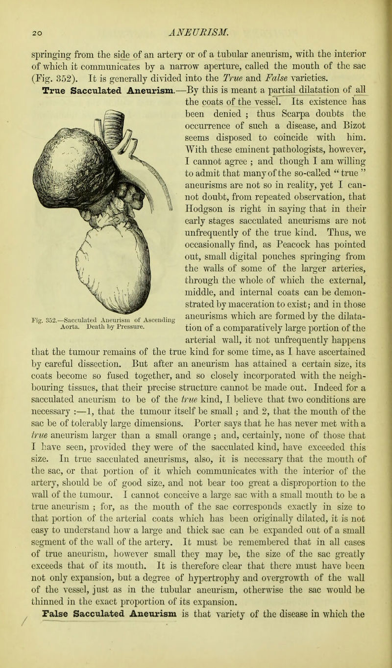 302.—Sacculated Aneurism of Ascending Aorta. Death by Pressure. springing from the side of an artery or of a tubular aneurism, with the interior of which it communicates by a narrow aperture, called the mouth of the sac (Fig. 352). It is generally divided into the True and False varieties. True Sacculated Aneurism.—By this is meant a partial dilatation of all the coats of the vessel. Its existence has been denied ; thus Scarpa doubts the occurrence of such a disease, and Bizot seems disposed to coincide with him. With these eminent pathologists, however, I cannot agree ; and though I am willing to admit that many of the so-called  true  aneurisms are not so in reality, yet I can- not doubt, from repeated observation, that Hodgson is right in saying that in their early stages sacculated aneurisms are not unfrequently of the true kind. Thus, we occasionally find, as Peacock has pointed out, small digital pouches springing from the walls of some of the larger arteries, through the whole of which the external, middle, and internal coats can be demon- strated by maceration to exist; and in those aneurisms which are formed by the dilata- tion of a comparatively large portion of the arterial wall, it not unfrequently happens that the tumour remains of the true kind for some time, as I have ascertained by careful dissection. But after an aneurism has attained a certain size, its coats become so fused together, and so closely incorporated with the neigh- bouring tissues, that their precise structure cannot be made out. Indeed for a sacculated aneurism to be of the true kind, I believe that two conditions are necessary :—1, that the tumour itself be small; and 2, that the mouth of the sac be of tolerably large dimensions. Porter says that he has never met with a true aneurism larger than a small orange ; and, certainly, none of those that I have seen, provided they were of the saccidatcd kind, have exceeded this size. In true sacculated aneurisms, also, it is necessary that the mouth of the sac, or that portion of it which communicates with the interior of the artery, should be of good size, and not bear too great a disproportion to the wall of the tumour. I cannot conceive a large sac with a small mouth to be a true aneurism ; for, as the mouth of the sac corresponds exactly in size to that portion of the arterial coats which has been originally dilated, it is not easy to understand how a large and thick sac can be expanded out of a small segment of the wall of the artery. It must be remembered that in all cases of true aneurism, however small they may be, the size of the sac greatly exceeds that of its mouth. It is therefore clear that there must have been not only expansion, but a degree of hyper trophy and overgrowth of the wall of the vessel, just as in the tubular aneurism, otherwise the sac would be thinned in the exact proportion of its expansion. False Sacculated Aneurism is that variety of the disease in which the