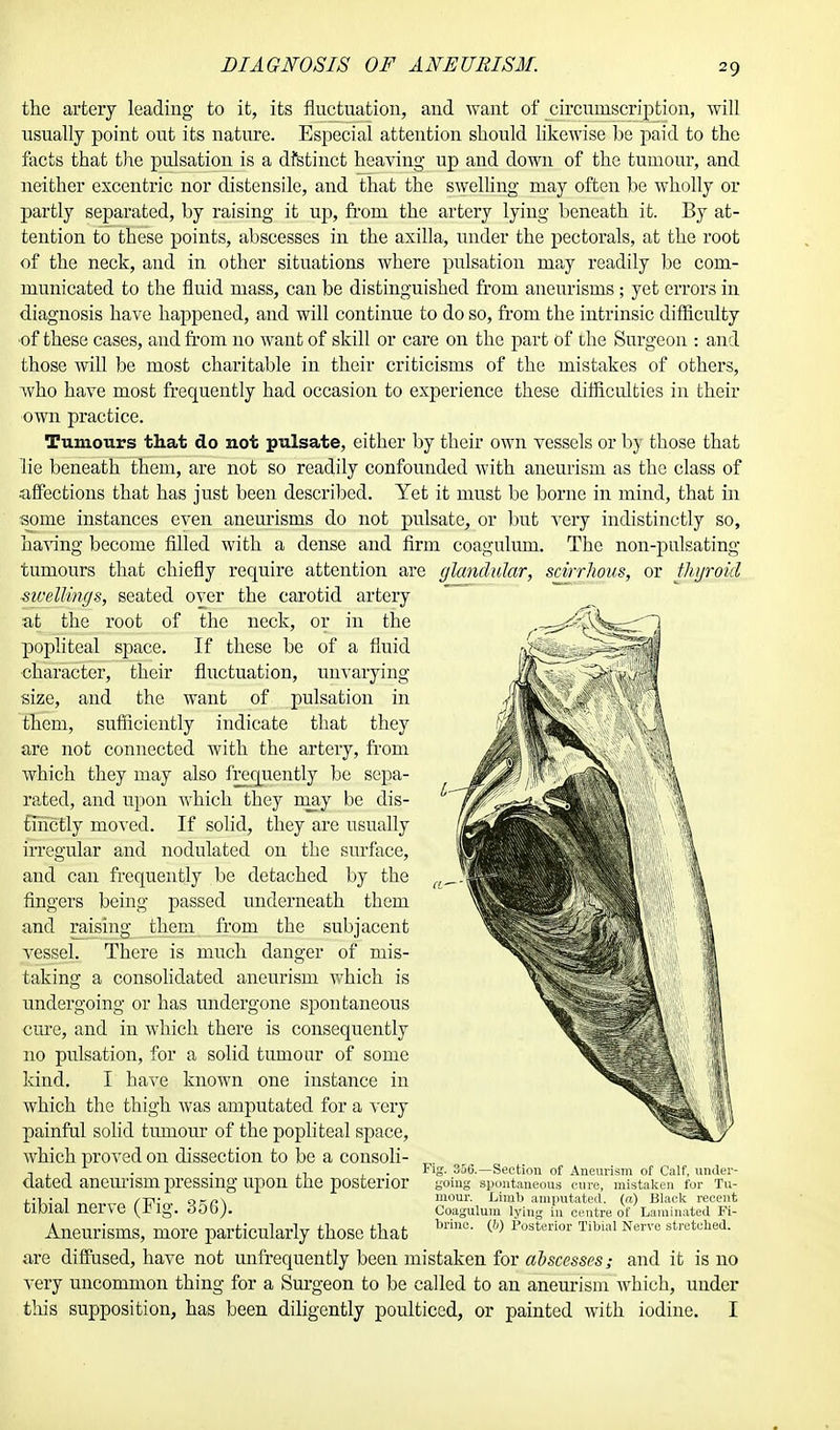 the artery leading to it, its fluctuation, and want of circumscription, will usually point out its nature. Especial attention should likewise be paid to the facts that the pulsation is a dfstinct heaving up and down of the tumour, and neither excentric nor distensile, and that the swelling may often be wholly or partly separated, by raising it up, from the artery lying beneath it. By at- tention to these points, abscesses in the axilla, under the pectorals, at the root of the neck, and in other situations where pulsation may readily be com- municated to the fluid mass, can be distinguished from aneurisms ; yet errors in diagnosis have happened, and will continue to do so, from the intrinsic difficulty ■of these cases, and from no want of skill or care on the part of ihe Surgeon : and those will be most charitable in their criticisms of the mistakes of others, who have most frequently had occasion to experience these difficulties in their own practice. Tumours that do not pulsate, either by their own vessels or by those that lie beneath them, are not so readily confounded with aneurism as the class of affections that has just been described. Yet it must be borne in mind, that in some instances even aneurisms do not pulsate, or but very indistinctly so, having become filled with a dense and firm coagulum. The non-pulsating tumours that chiefly require attention are glandular, scirrhous, or thyroid swellings, seated over the carotid artery at the root of the neck, or in the popliteal space. If these be of a fluid character, their fluctuation, unvarying size, and the want of pulsation in them, sufficiently indicate that they are not connected with the artery, from which they may also frequently be sepa- rated, and upon which they may be dis- tinctly moved. If solid, they are usually irregular and nodulated on the surface, and can frequently be detached by the fingers being passed underneath them and raising them from the subjacent vessel. There is much clanger of mis- taking a consolidated aneurism which is undergoing or has undergone spontaneous cure, and in which there is consequently no pulsation, for a solid tumour of some kind. I have known one instance in which the thigh was amputated for a very painful solid tumour of the popliteal space, which proved on dissection to be a consoli- dated aneurism pressing upon the posterior tibial nerve (Fig. 356). Aneurisms, more particularly those that are diffused, have not unfrequently been mistaken for abscesses; and it is no very uncommon thing for a Surgeon to be called to an aneurism which, under this supposition, has been diligently poulticed, or painted with iodine. I Fig. 35G.—Section of Aneurism of Calf, under- going spontaneous cure, mistaken for Tu- mour. Limb amputated, (a) Black recent Coagulum lying in centre of Laminated Fi- brinc. (Ji) Posterior Tibial Nerve stretched.