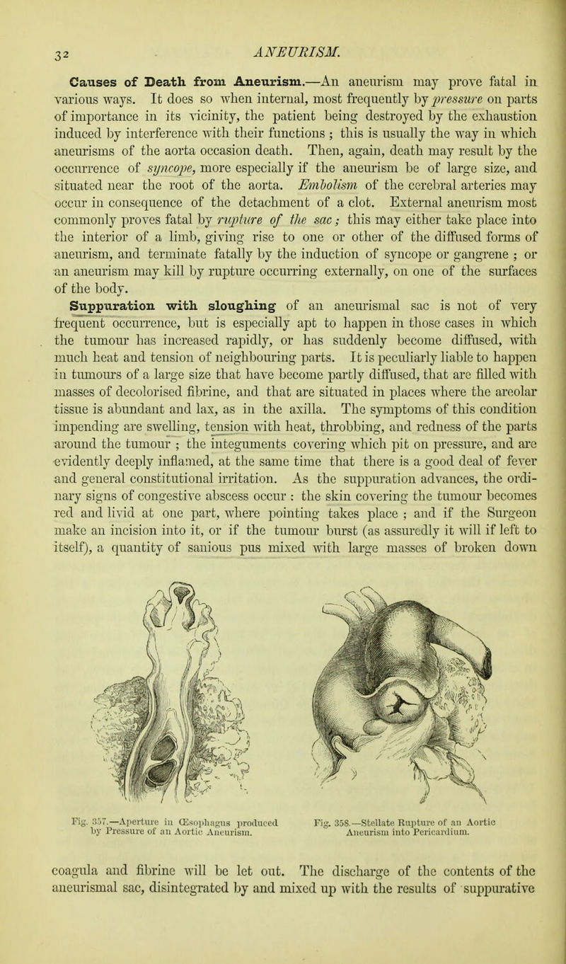 3 2 Causes of Death from Aneurism.—An aneurism may prove fatal in various ways. It does so when internal, most frequently by pressure on parts of importance in its vicinity, the patient being destroyed by the exhaustion induced by interference with their functions ; this is usually the way in which aneurisms of the aorta occasion death. Then, again, death may result by the occurrence of syncope, more especially if the aneurism be of large size, and situated near the root of the aorta. Embolism of the cerebral arteries may occur in consequence of the detachment of a clot. External aneurism most commonly proves fatal by rupture of tlie sac; this may either take place into the interior of a limb, giving rise to one or other of the diffused forms of aneurism, and terminate fatally by the induction of syncope or gangrene ; or an aneurism may kill by rupture occurring externally, on one of the surfaces of the body. Suppuration with sloughing of an aneurismal sac is not of very frequent occurrence, but is especially apt fco happen in those cases in which the tumour has increased rapidly, or has suddenly become diffused, with much heat and tension of neighbouring parts. It is peculiarly liable to happen in tumours of a large size that have become partly diffused, that are filled with masses of decolorised fibrine, and that are situated in places where the areolar tissue is abundant and lax, as in the axilla. The symptoms of this condition impending are swelling, tension with heat, throbbing, and redness of the parts around the tumour ; the integuments covering which pit on pressure, and are evidently deeply inflamed, at the same time that there is a good deal of fever and general constitutional irritation. As the suppuration advances, the ordi- nary signs of congestive abscess occur : the skin covering the tumour becomes red and livid at one part, where pointing takes place ; and if the Surgeon make an incision into it, or if the tumour burst (as assuredly it will if left to itself), a quantity of sanious pus mixed with large masses of broken clown Fiy. 857.—Aperture in GBsophagus produced by Pressure of an Aortic Aneurism. Fig. 358.— Stellate Rupture of an Aortic Aneurism into Pericardium. coagula and fibrine will be let out. The discharge of the contents of the aneurismal sac, disintegrated by and mixed up with the results of suppurative