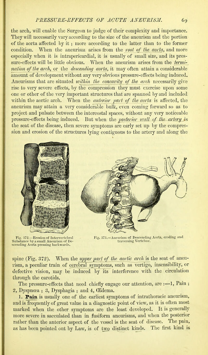 the arch, will enable the Surgeon to judge of their complexity and importance. They will necessarily vary according to the size of the aneurism and the portion cf the aorta affected by it ; more according to the latter than to the former condition. When the aneurism arises from the root of the aorta, and more especially when it is intrapericardial, it is usually of small size, and its pres- sure-effects Avill be little obvious. When the aneurism arises from the termi- nation of the arch, or the descending aorta, it may often attain a considerable amount of development without any very obvious pressure-effects being induced. Aneurisms that are situated within the concavity of the arch necessarily give rise to very severe effects, by the compression they must exercise upon some one or other of the very important structures that are spanned by and included within the aortic arch. When the anterior part of the aorta is affected, the aneurism may attain a very considerable bulk, even coming forward so as to project and pulsate between the intercostal spaces, without any very noticeable pressure-effects being induced. But when the posterior tvall of the. artery is the seat of the disease, then severe symptoms are early set up by the compres- sion and erosion of the structures lying contiguous to the artery and along the spine (Fig. 372). When the v^perjmrt of the aortic arch is the seat of aneu- rism, a peculiar train of cerebral symptoms, such as vertigo, insensibility, or defective vision, may be induced by its interference with the circulation through the carotids. The pressure-effects that need chiefly engage our attention, are :—1, Pain ; 2, Dyspnoea ; 3, Dysphagia ; and 4, (Edema. 1. Pain is usually one of the earliest symptoms of intrathoracic aneurism, and is frequently of great value in a diagnostic point of view, as it is often most marked when the other symptoms are the least developed. It is generally more severe in sacculated than in fusiform aneurisms, and when the posterior rather than the anterior aspect of the vessel is the seat of disease. The pain, as has been pointed out by Law, is of two distinct kinds. The first kind is Fig. 37:2.—Erosion of Intervertebral Substance by a small Aneurism of De- scending Aorta pressing backwards. Fig. 373 —Aneurism of Descending Aorta, eroding and traversing Vertebrae,