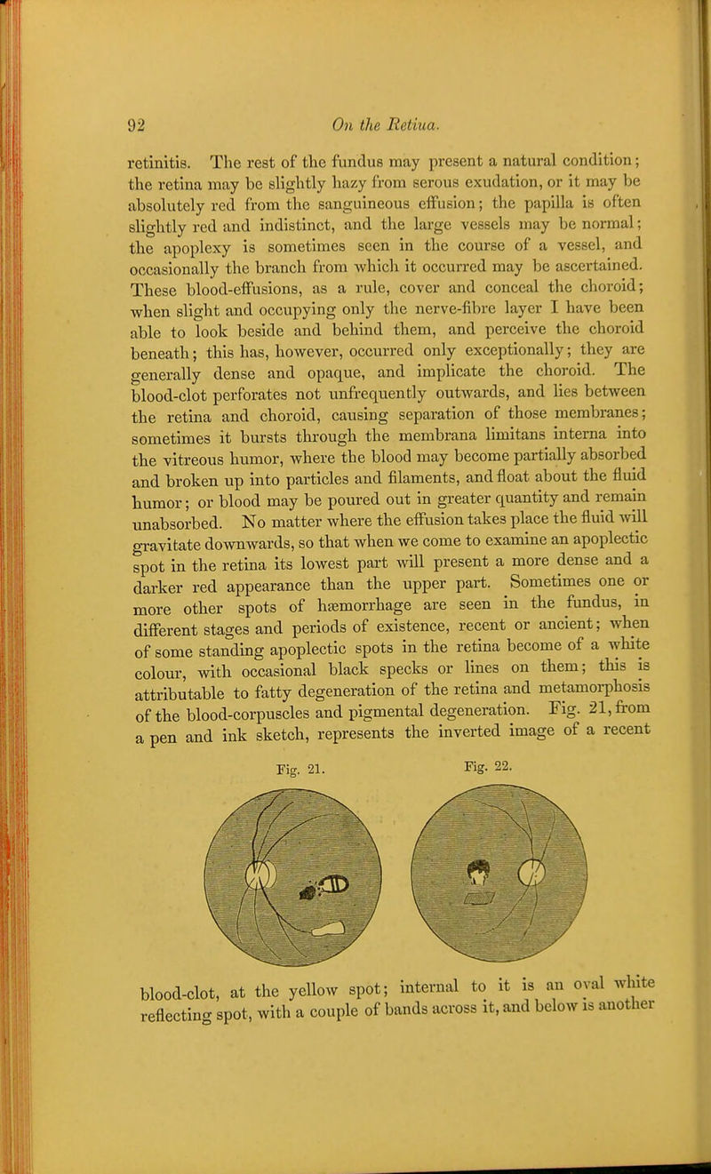 retinitis. The rest of the fundus may present a natural condition; the retina may be slightly hazy from serous exudation, or it may be absolutely red from the sanguineous effusion; the papilla is often slightly red and indistinct, and the large vessels may be normal; the apoplexy is sometimes seen in the course of a vessel, and occasionally the branch from which it occurred may be ascertained. These blood-elFusions, as a rule, cover and conceal the choroid; when slight and occupying only tlie nerve-fibre layer I have been able to look beside and behind them, and perceive the choroid beneath; this has, however, occurred only exceptionally; they are generally dense and opaque, and implicate the choroid. The blood-clot perforates not unfrequently outwards, and lies between the retina and choroid, causing separation of those membranes; sometimes it bursts through the menibrana limitans interna into the vitreous humor, where the blood may become partially absorbed and broken up into particles and filaments, and float about the fluid liumor; or blood may be poured out in greater quantity and remain unabsorbed. No matter where the effusion takes place the fluid Avill gravitate downwards, so that when we come to examine an apoplectic spot in the retina its lowest part will present a more dense and a darker red appearance than the upper part. Sometimes one or more other spots of hfemorrhage are seen in the fundus, m different stages and periods of existence, recent or ancient; when of some standing apoplectic spots in the retina become of a white colour, with occasional black specks or lines on them; this is attributable to fatty degeneration of the retina and metamorphosis of the blood-corpuscles and pigmental degeneration. Fig. 21, from a pen and ink sketch, represents the inverted image of a recent Tig. 21. Fig. 22. blood-clot, at the yellow spot; Internal to it is an oval white reflecting spot, with a couple of bands across it, and below is another