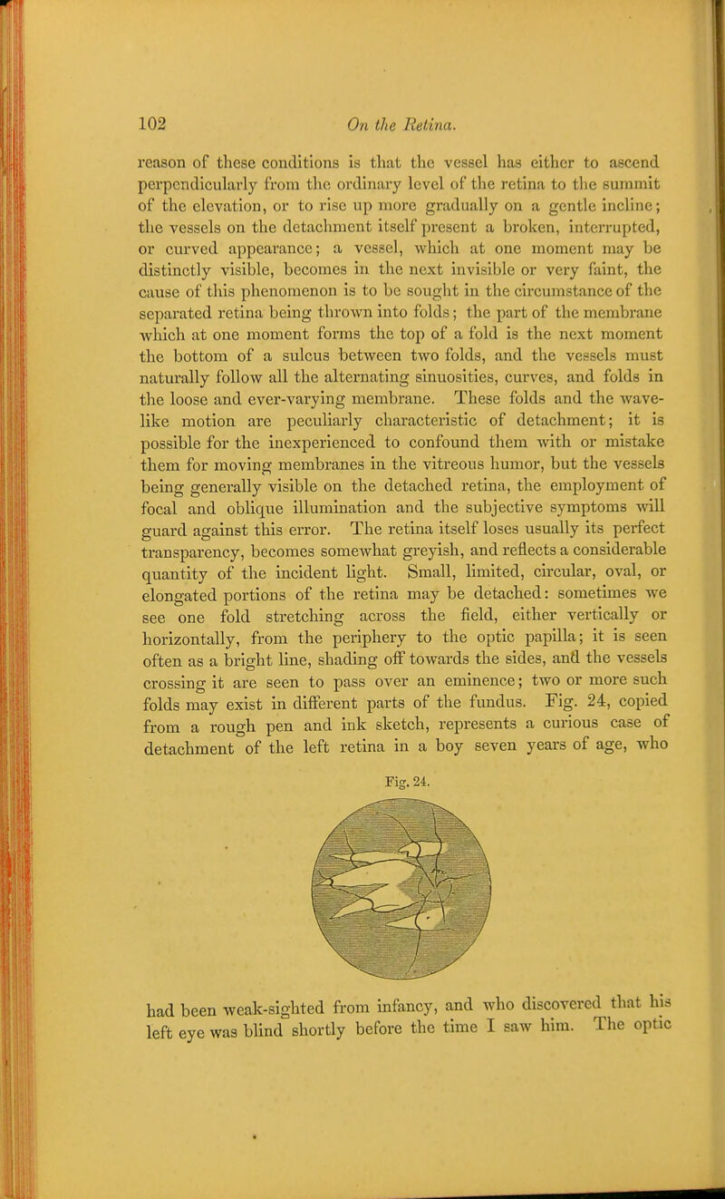I'eason of these conditions is that the vessel has either to ascend perpendicularly from the ordinary level of the retina to the summit of the elevation, or to rise up more gradually on a gentle incline; the vessels on the detachment itself present a broken, interrupted, or curved appearance; a vessel, which at one moment may be distinctly visible, becomes in the next invisible or very faint, the cause of this phenomenon is to be sought in the circumstance of the separated retina being thrown into folds; the part of the membrane which at one moment forms the top of a fold is the next moment the bottom of a sulcus between two folds, and the vessels must naturally follow all the alternating sinuosities, curves, and folds in the loose and ever-varying membrane. These folds and the wave- like motion are peculiarly characteristic of detachment; it is possible for the inexperienced to confound them with or mistake them for moving membranes in the vitreous humor, but the vessels being generally visible on the detached retina, the employment of focal and oblique illumination and the subjective symptoms will guard against this error. The retina itself loses usually its perfect transparency, becomes somewhat greyish, and reflects a considerable quantity of the incident light. Small, limited, circular, oval, or elongated portions of the retina may be detached: sometimes we see one fold stretching across the field, either vertically or horizontally, from the periphery to the optic papilla; it is seen often as a bright line, shading oiF towards the sides, and the vessels crossing it are seen to pass over an eminence; two or more such folds may exist in difierent parts of the fundus. Fig. 24, copied from a rough pen and ink sketch, represents a curious case of detachment of the left retina in a boy seven years of age, who Fig. 24. had been weak-sighted from infancy, and who discovered that his left eye was blind shortly before the time I saw him. The optic