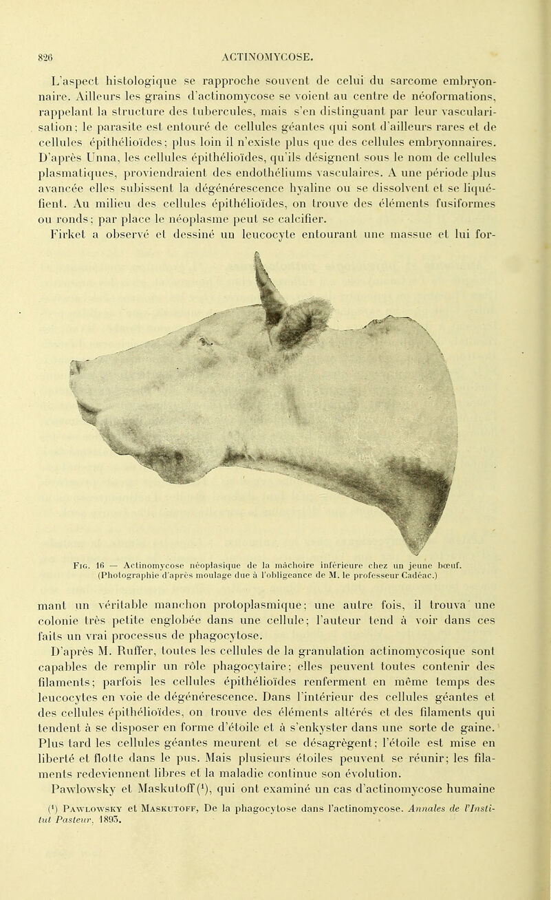 L'aspect histologique se rapproche souvent de celui du sarcome embryon- naire. Ailleurs les grains d'actinomycose se voient au centre de néoformations, rappelant la structure des tubercules, mais s'en distinguant par leur vasculari- sation ; le parasite est entouré de cellules géantes qui sont d'ailleurs rares et de cellules épithélioïdes; plus loin il n'existe plus que des cellules embryonnaires. D'après Unna, les cellules épithélioïdes, qu'ils désignent sous le nom de cellules plasmatiques, proviendraient des endothéliums vasculaires. A une période plus avancée elles subissent la dégénérescence hyaline ou se dissolvent et se liqué- fient. Au milieu des cellules épithélioïdes, on trouve des éléments fusiformes ou ronds ; par place le néoplasme peut se calcifier. Firket a observé et dessiné un leucocyte entourant une massue et lui for- Fig. 16 — Actinomycose néoplasique de la mâchoire inférieure chez un jeune bœuf. (Photographie d'après moulage due à l'obligeance de M. le professeur Cadéac.) mant un véritable manchon protoplasmique ; une autre fois, il trouva 'une colonie très petite englobée dans une cellule; l'auteur tend à voir dans ces faits un vrai processus de phagocytose. D'après M. Ruffer, toutes les cellules de la granulation actinomycosique sont capables de remplir un rôle phagocytaire ; elles peuvent toutes contenir des filaments; parfois les cellules épithélioïdes renferment en même temps des leucocytes en voie de dégénérescence. Dans l'intérieur des cellules géantes et des cellules épithélioïdes, on trouve des éléments altérés et des filaments qui tendent à se disposer en forme d'étoile et à s'enkyster dans une sorte de gaine. Plus tard les cellules géantes meurent et se désagrègent; l'étoile est mise en liberté et flotte dans le pus. Mais plusieurs étoiles peuvent se réunir; les fila- ments redeviennent libres et la maladie continue son évolution. Pawlowsky et Maskutoff (*), qui ont examiné un cas d'actinomycose humaine (') Pawlowsky et Maskutoff, De la phagocytose dans l'actinomycose. Annales de l'Insti- tut Pasteur, 1893.