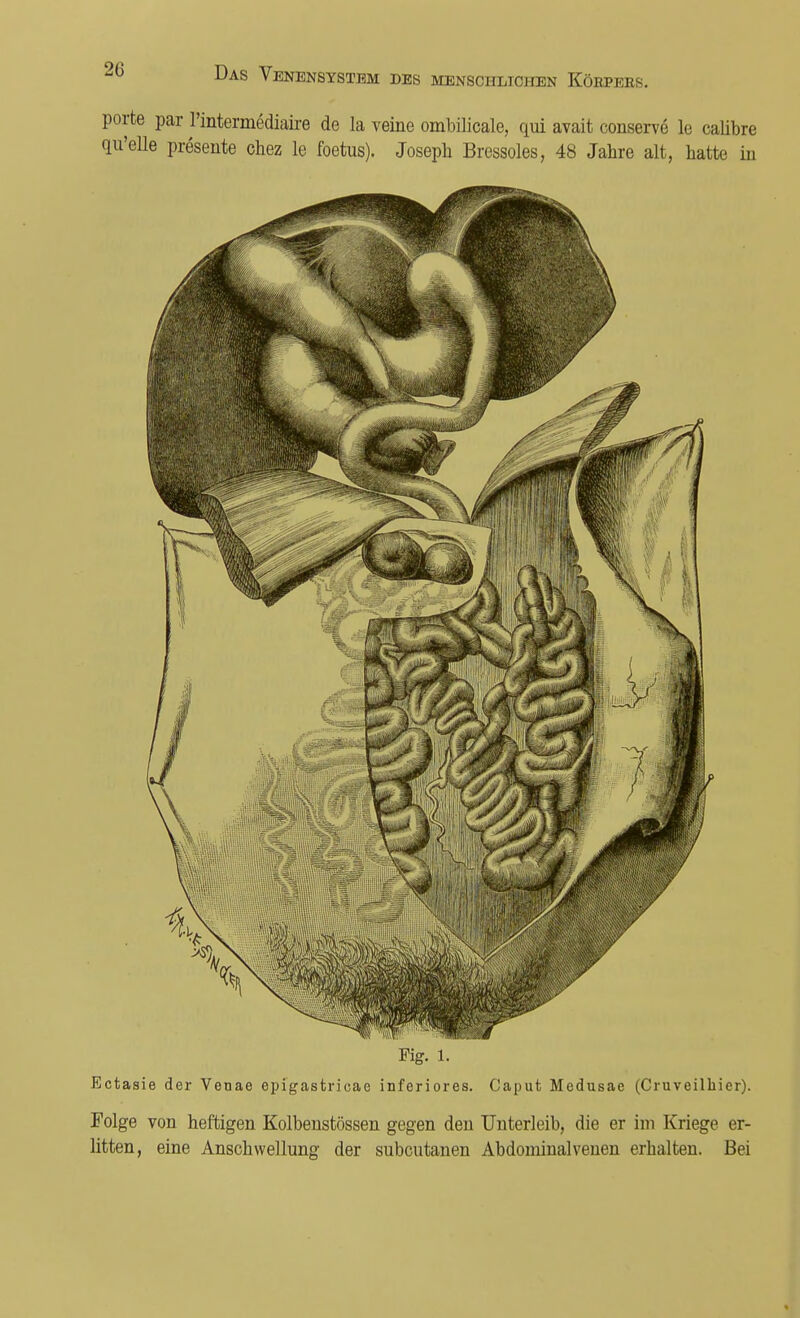 porte par l'intermediaire de la veine ombilicale, qui avait conserve le calibre qu'elle presente chez le foetus). Joseph Bressoles, 48 Jahre alt, hatte in Fig. l. Ectasie der Venae epigastricae inferiores. Caput Medusae (Cruveilhier). Folge von heftigen Kolbenstössen gegen den Unterleib, die er im Kriege er- litten, eine Anschwellung der subcutanen Abdominalveuen erhalten. Bei