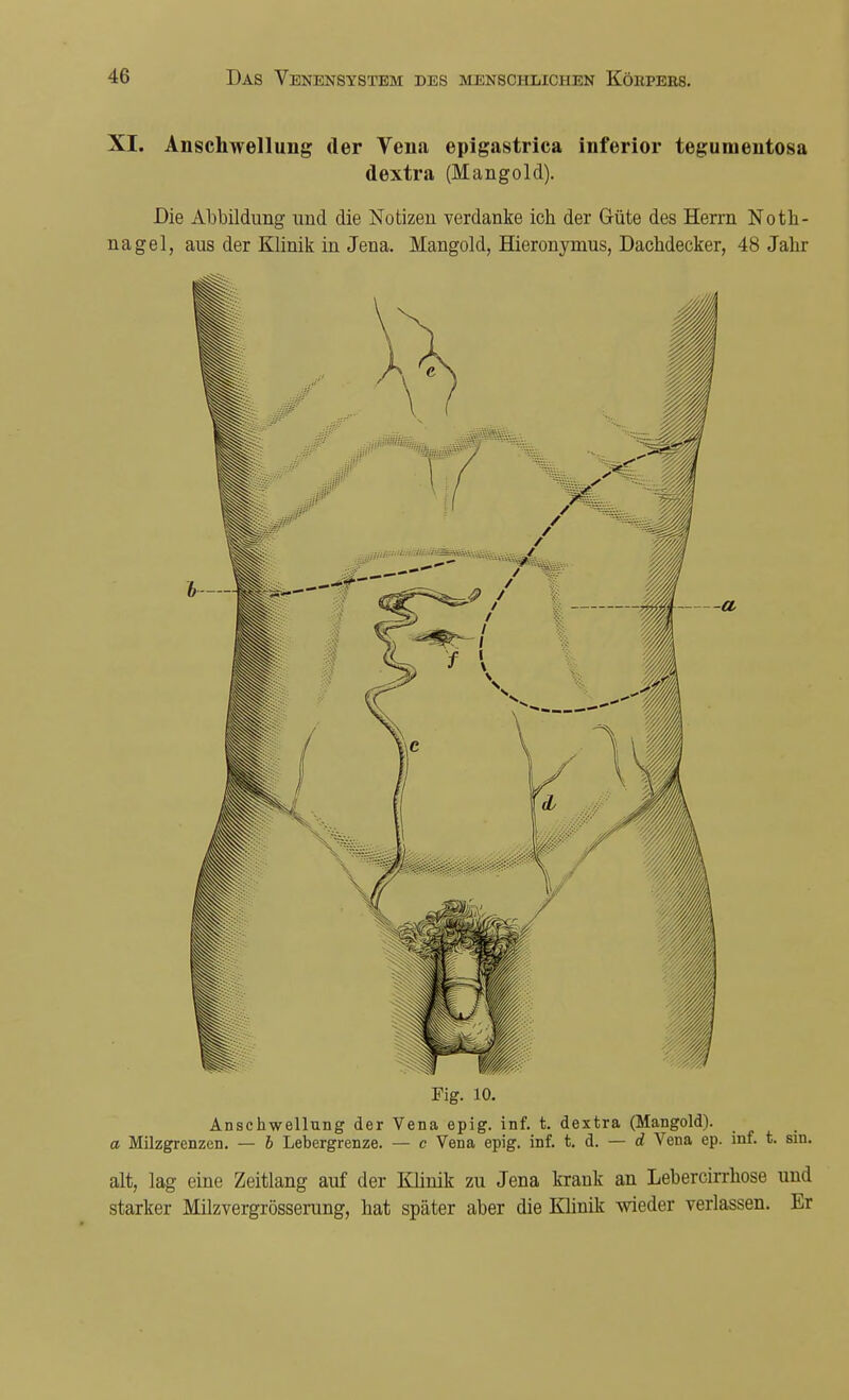 XI. Anschwellung der Vena epigastrica inferior tegumentosa dextra (Mangold). Die Abbildung und die Notizen verdanke ich der Güte des Herrn Noth- nagel, aus der Klinik in Jena. Mangold, Hieronymus, Dachdecker, 48 Jahr Fig. 10. Anschwellung der Vena epig. inf. t. dextra (Mangold). a Milzgrenzen. — b Lebergrenze. — c Vena epig. inf. t. d. — d Vena ep. inf. t. sin. alt, lag eine Zeitlang auf der Klinik zu Jena krank an Lebercirrhose und starker Milzvergrösserung, hat später aber die Klinik wieder verlassen. Er