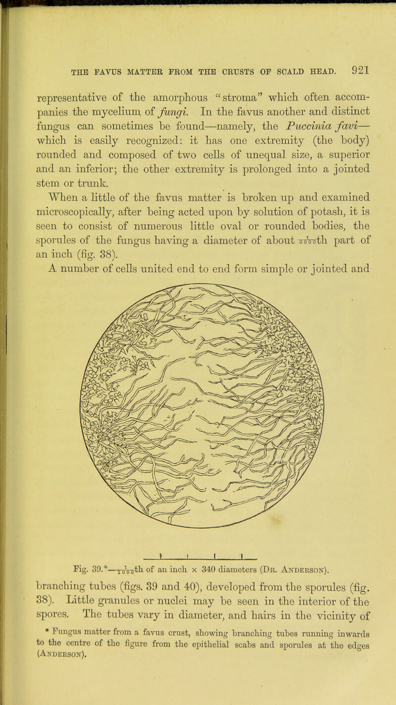 representative of the amorphous stroma which often accom- panies the mycelium, of fwngi. In the favus another and distinct fungus can sometimes be found—namely, the Puccinia favi— which is easily recognized: it has one extremity (the body) rounded and composed of two cells of unequal size, a superior and an inferior; the other extremity is prolonged into a jointed stem or tnmk. When a little of the favus matter is broken up and examined microscopically, after being acted upon by solution of potash, it is seen to consist of numerous little oval or rounded bodies, the sporules of the fungus having a diameter of about imnrth part of an inch (fig. 88). A number of cells united end to end form simple or jointed and * I I » Pig. 39.*—nrinrtli of an incli x 340 diameters (Dr. Andebson). branching tubes (figs. 39 and 40), developed from the sporules (fig. 38). Little gi-anules or nuclei may be seen in the interior of the spores. The tubes vary in diameter, and hairs in the vicinity of • Fungus matter from a favus crust, showing branching tubes running inwards to the centre of the figure from the epithelial scabs and sporules at the edges (Anderson). °