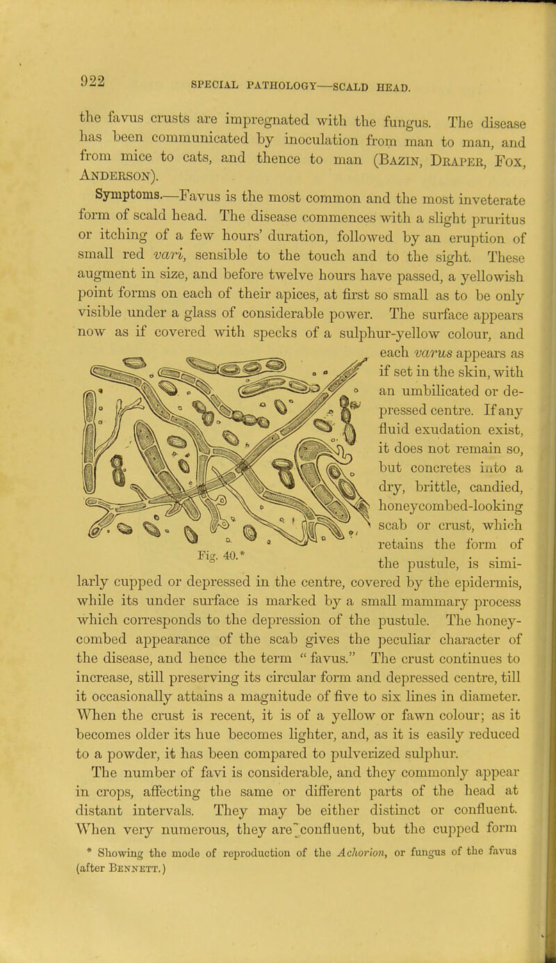 the favTis crusts are impregnated with the fungus. The disease has been communicated by inoculation from man to man, and from mice to cats, and thence to man (Bazin, Deapee, Fox, Andeeson). Symptoms—Favus is the most common and the most inveterate form of scald head. The disease commences with a slight pruritus or itching of a few hours' duration, followed by an eruption of small red vari, sensible to the touch and to the sight. These augment in size, and before twelve hours have passed, a yellowish point forms on each of their apices, at fii'st so small as to be only visible under a glass of considerable power. The surface appears now as if covered with specks of a sulphur-yellow colour, and each varus appears as if set in the skin, with an umbilicated or de- pressed centre. If any fluid exudation exist, it does not remain so, but concretes iiito a dry, brittle, candied, honeycombed-looking scab or crust, which retains the form of the pustule, is simi- larly cupped or depressed in the centre, covered by the epidermis, while its under surface is marked by a small mammary process which corresponds to the depression of the pustule. The honey- combed appearance of the scab gives the peculiar character of the disease, and hence the term  favus. The crust continues to increase, still preserving its circular form and depressed centre, till it occasionally attains a magnitude of five to six lines in diameter. When the crust is recent, it is of a yellow or fawn colour; as it becomes older its hue becomes lighter, and, as it is easily reduced to a powder, it has been compared to pulverized sulphur. The number of favi is considerable, and they commonly appear in crops, affecting the same or different parts of the head at distant intervals. They may be either distinct or confluent. When very numerous, they areconfluent, but the cupped form * Showing the mode of reproduction of the Achorion, or fungus of the favua (after Bennett.)