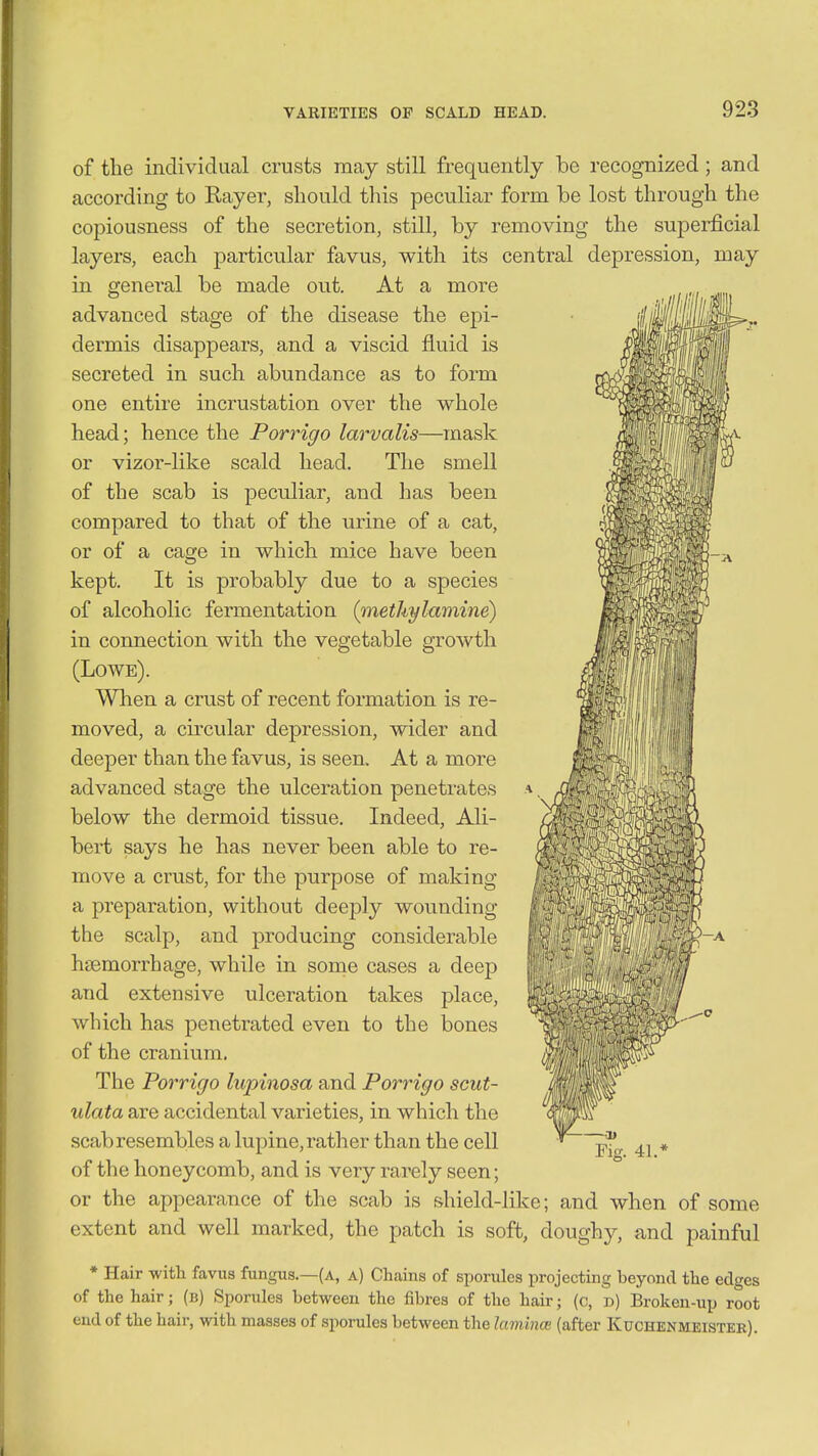 of the individual crusts may still frequently be recognized; and according to Rayer, should this peculiar form be lost through the copiousness of the secretion, still, by removing the superficial layers, each particular favus, with its central depression, may in general be made out. At a more advanced stage of the disease the epi- dermis disappears, and a viscid fluid is secreted in such abundance as to form one entire incrustation over the whole head; hence the Porrigo larvalis—mask or vizor-like scald head. The smell of the scab is peculiar, and has been compared to that of the urine of a cat, or of a cage in which mice have been kept. It is probably due to a species of alcoholic fermentation (inethylamine) in connection with the vegetable growth (Lowe). When a crust of recent formation is re- moved, a circular depression, wider and deeper than the favus, is seen. At a more advanced stage the ulceration penetrates below the dermoid tissue. Indeed, Ali- bert says he has never been able to re- move a crust, for the purpose of making a preparation, without deeply wounding the scalp, and producing considerable haemorrhage, while in some cases a deep and extensive ulceration takes place, which has penetrated even to the bones of the cranium. The Porrigo lupinosa and Porrigo scut- ulata are accidental varieties, in which the scab resembles a lupine, rather than the cell of the honeycomb, and is very rarely seen; or the appearance of the scab is shield-like; and when of some extent and well marked, the patch is soft, doughy, and painful * Hair with favus fungus.—(a, a) Chains of sporules projecting beyond the edges of the hair; (b) Sporules between the fibres of the hair; (c, t>) Broken-up root end of the hair, with masses of sporules between the lamince (after Kuchenmeister).