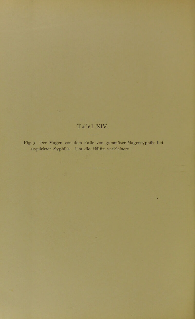 Fig. 3. Der Magen von dem Falle von gummöser Magensyphilis bei acquirirter Syphilis. Um die Hälfte verkleinert.