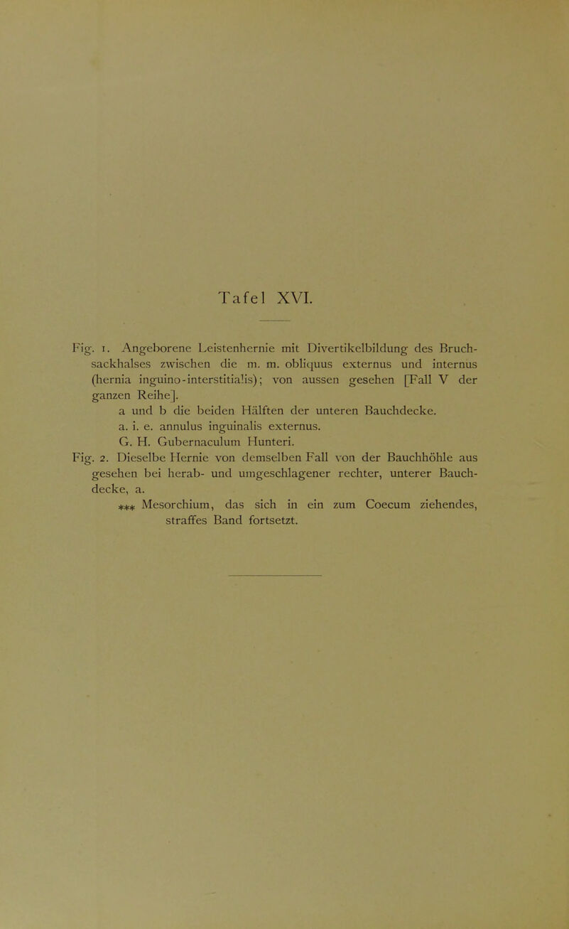 Fig. i. Angeborene Leistenhernie mit Divertikelbildung des Bruch- sackhalses zwischen die m. m. obliquus externus und internus (hernia inguino-interstitialis); von aussen gesehen [Fall V der ganzen Reihe]. a und b die beiden Hälften der unteren Bauchdecke. a. i. e. annulus inguinalis externus. G. H. Gubernaculum Hunteri. Fig. 2. Dieselbe Hernie von demselben Fall von der Bauchhöhle aus gesehen bei herab- und umgeschlagener rechter, unterer Bauch- decke, a. **# Mesorchium, das sich in ein zum Coecum ziehendes, straffes Band fortsetzt.