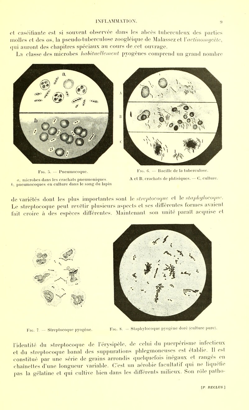 et caséifianle est si souvent observée dans les abcès lulxn-culeux des parties molles et des os, la pseudo-tuberculose zoogléique de Malassez et Vartinomycète, (\m auront des chapitres spéciaux au cours de cet ouvrage. La classe des microlx's hahitiieUernent pyogènes comprend un grand nomljre FiG. — l'nciiiiiocoquc. I''- ^ B.icillc df la liiIxTCuIosc. n, microbes dans les crachats pneumoniqucs A cl B, crachats de phlisiques. — C, culture. h, pneumocoques en culture dans le sang du lapin de variétés dont les plus importantes sont le xlreptocoqiie cl le i^tnphylocrxiur. Le streptocoque peut revèlir plusieurs aspects et ses diflerenles formes avaient l'ait croire à des espèces diflerentes. Maintenant sou unité paraît acquise et FiG. 7. - Streptocoque pyogène. Fio. S. - Staphylocoque pyogùne doré (culture pure). l'idenlilé du streptocoque de l'érvsipèle, de <-eliii du puerpérisme inlVciieux et du streptocoque banal des suppurations phlegmoneuses est établie. Il est constitué par une série de grains arrondis quelquefois inégaux et rangés en chaînettes d'une longueur Aariable. C'est un aérobie facultatif qui ne liquéfie pas la gélatine et qiii cultive l)ien dans les dilTérents milieux. Son rôle patho-