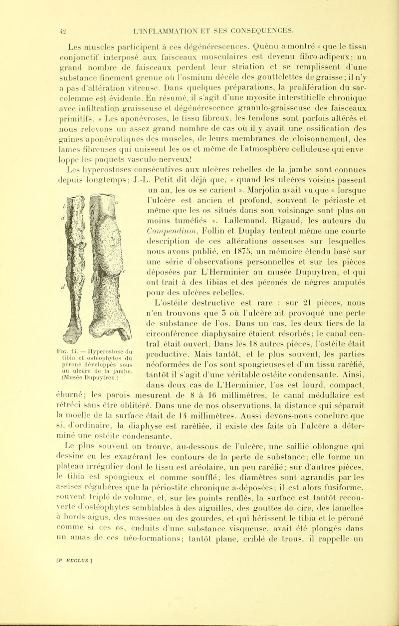 Les muscles participent à ces dégénérescences. Quénu a montré « que le tissu conjonctit interposé aux faisceaux musculaires est devenu fdjro-adipeux; un grand nombre de faisceaux perdent leur striation et se remplissent d'une suijslance finement grenue où l'osmium décèle des gouttelettes dégraisse; il n'y a pas d'altération vitreuse. Dans quelques préparations, la prolifération du sar- colemme esjt évidente. En résumé, il s'agit d'une myosite interstitielle chronique avec infdtration graisseuse et dégénérescence granulo-graisseuse des faisceaux primitifs. » Les aponévroses, le tissu fd^reux, les tendons sont parfois altérés et nous relevons un assez grand nombre de cas où il y avait une ossification des gaines aponévrotiques des muscles, de leurs membranes de cloisonnement, des lames fibreuses qui unissent les os et même de l'atmosphère celluleuse qui enve- loppe les paquets vasculo-nerveux! Les hyperostoses consécutives aux ulcères rebelles de la jambe sont connues depuis longtemps; J.-L. Petit dit déjà que, « quand les ulcères voisins passent un an, les os se carient ». Marjolin avait vu que « lorsque l'ulcère est ancien et profond, souvent le périoste et même cjue les os situés dans son voisinage sont plus ou moins tuméfiés ». Lallemand, Rigaud, les auteurs du Compendium, Follin et Duplay tentent même une courte description de ces altérations osseuses sur lesquelles nous avons publié, en 1875, un mémoire étendu basé sur une série d'observations personnelles et sur les pièces déposées par L'Herminier au musée Dupuytren, et qui ont trait à des tibias et des péronés de nègres amputés pour des ulcères rebelles. L'ostéite destructive est rare : sur 21 pièces, nous n'en trouvons que 5 où l'ulcère ait provoqué une perte de substance de l'os. Dans un cas, les deux tiers de la circonférence diaphysaire étaient résorbés; le canal cen- tral était ouvert. Dans les 18 autres pièces, l'ostéite était productive. Mais tantôt, et le plus souvent, les parties néoformées de l'os sont spongieuses et d'un tissu raréfié, tantôt il s'agit d'une véritable ostéite condensante. Ainsi, dans deux cas de L'Herminier, l'os est lourd, compact, éburné; les parois mesurent de 8 à 16 millimètres, le canal médullaire est rétréci sans être oblitéré. Dans une de nos observations, la distance qui séparait la moelle de la surface était de 14 millimètres. Aussi devons-nous conclure que si, d'ordinaire, la diaphyse est raréfiée, il existe des faits où l'ulcère a déter- miné une ostéite condensante. Le plus souvent on trouve, au-dessous de l'ulcère, une saillie oblongue qui dessine en les exagérant les contours de la perte de substance ; elle forme un plateau irrégulier dont le tissu est aréolaire, un peu raréfié; sur d'autres pièces, le tibia est spongieux et comme soufflé; les diamètres sont agrandis parles assises régulières que la périostite chronique a-déposées; il est alors fusiforme, souvent triplé de volume, et, sur les points renflés, la surface est tantôt recou- verte d'ostéophytes semblables à des aiguilles, des gouttes de cire, des lamelles à bords aigus, des massues ou des gourdes, et qui hérissent le tibia et le péroné comme si ces os, enduits d'une substance visqueuse, avait été plongés dans un amas de ces néo-formations; tantôt plane, criblé de trous, il rappelle un FiG. IL — Hyperoslose du tibia eL ostéopliytes du péroné développés sous un ulcère de la jambe. (Musée Dupuytren.)