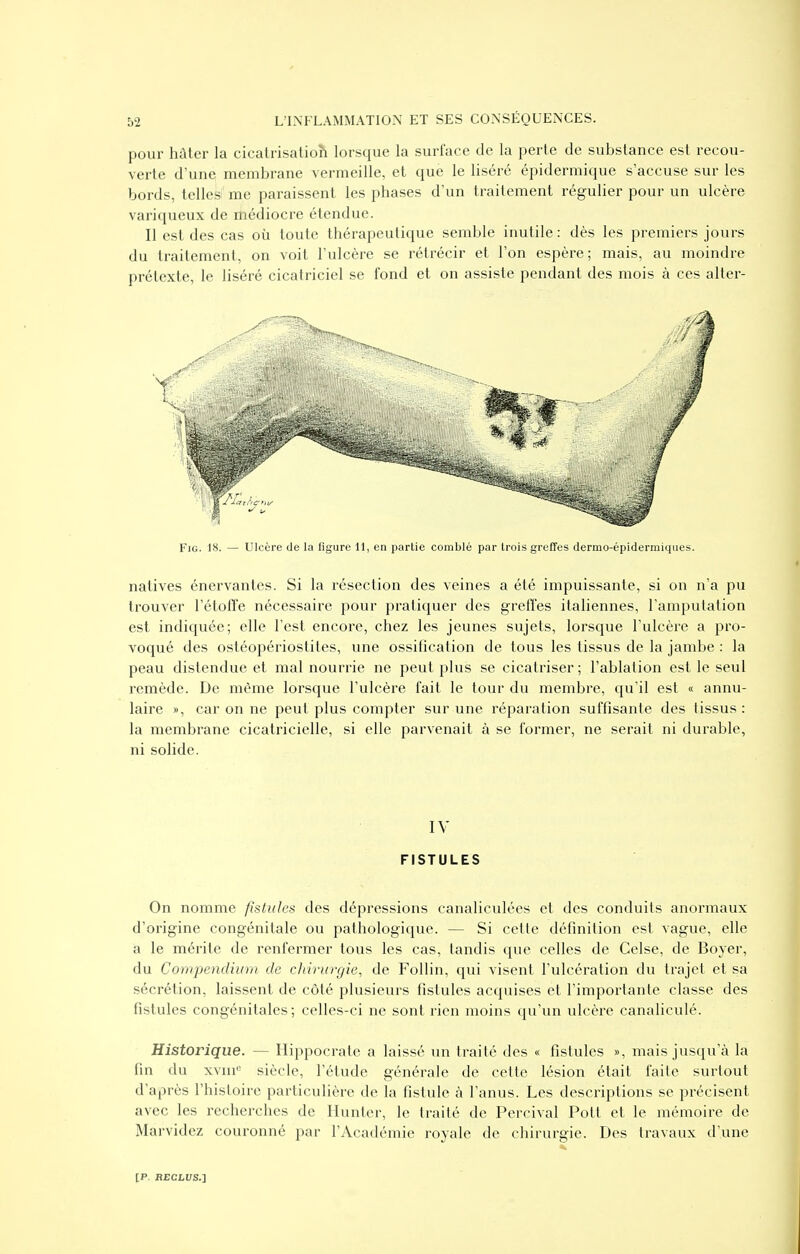 pour hâter la cicatrisatioh lorsque la surface de la perle de substance est recou- verte d'une membrane vermeille, et que le liséré épiderraique s'accuse sur les bords, telles' me paraissent les phases d'un traitement régulier pour un ulcère variqueux de médiocre étendue. Il est des cas où toute thérapeutique semble inutile : dès les premiers jours du traitement, on voit l'ulcère se rétrécir et l'on espère; mais, au moindre prétexte, le liséré cicatriciel se fond et on assiste pendant des mois à ces alter- FiG. 18. — Ulcère de la figure 11, en partie comblé par trois greffes dermo-épideriniques. natives énervantes. Si la résection des veines a été impuissante, si on n'a pu trouver rétoffe nécessaire pour pratiquer des greffes italiennes, l'amputation est indiquée; elle l'est encore, chez les jeunes sujets, lorsque l'ulcère a pro- voqué des ostéopériostites, une ossification de tous les tissus de la jambe : la peau distendue et mal nourrie ne peut plus se cicatriser; l'ablation est le seul remède. De même lorsque l'ulcère fait le tour du membre, qu'il est « annu- laire », car on ne peut plus compter sur une réparation suffisante des tissus : la membrane cicatricielle, si elle parvenait à se former, ne serait ni durable, ni solide. IV FISTULES On nomme fistules des dépressions canaliculées et des conduits anormaux d'origine congénitale ou pathologique. — Si cette définition est vague, elle a le mérite de renfermer tous les cas, tandis que celles de Celse, de Boyer, du Compendhim de chirurgie, de Follin, qui visent l'ulcération du trajet et sa sécrétion, laissent de côté plusieurs fistules acquises et l'importante classe des fistules congénitales; celles-ci ne sont rien moins qu'un ulcère canaliculé. Historique. — Hippocrate a laissé un traité des « fistules », mais jusqu'à la fin du xvui'= siècle, l'étude générale de cette lésion était faite surtout d'après l'histoire particulière de la fistule à l'anus. Les descriptions se précisent avec les recherches de Hunter, le traité de Percival Pott et le mémoire de Marvidez couronné par l'Académie royale de chirurgie. Des travaux d'une