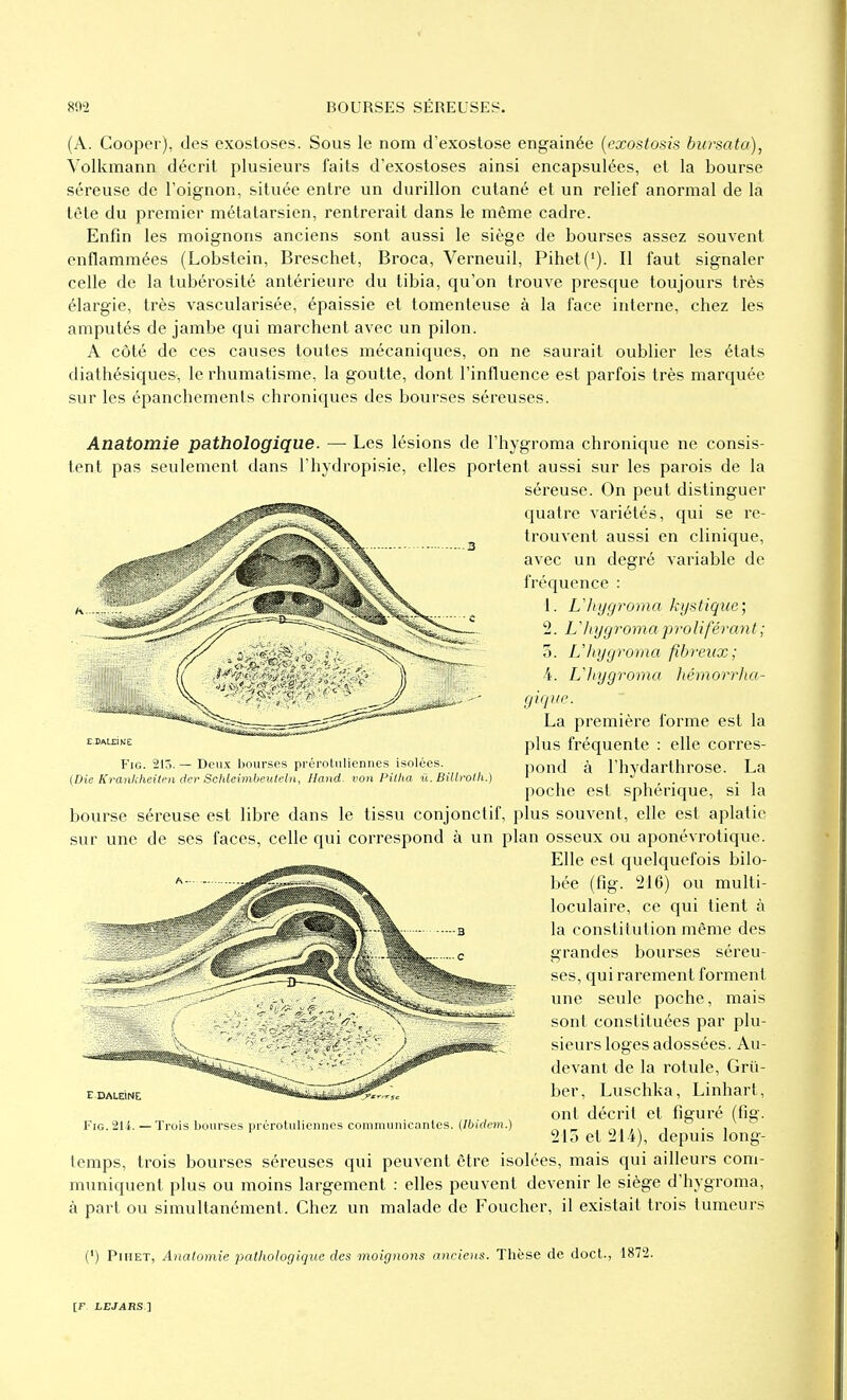 (A. Cooper), des exostoses. Sous le nom d'exostose engainée {cxostosis bursata), Volkmann décrit plusieurs faits d'exostoses ainsi encapsulées, et la bourse séreuse de l'oignon, située entre un durillon cutané et un relief anormal de la tête du premier métatarsien, rentrerait dans le même cadre. Enfin les moignons anciens sont aussi le siège de bourses assez souvent enflammées (Lobstein, Breschet, Broca, Verneuil, Pihet('). Il faut signaler celle de la tubérosilé antérieure du tibia, qu'on trouve presque toujours très élargie, très vascularisée, épaissie et tomenteuse à la face interne, chez les amputés de jambe qui marchent avec un pilon. A côté de ces causes toutes mécaniques, on ne saurait oublier les états diathésiques, le rhumatisme, la goutte, dont l'influence est parfois très marquée sur les épanchements chroniques des bourses séreuses. Anatomie pathologique. — Les lésions de l'hygroma chronique ne consis- tent pas seulement dans I hydropisie, elles portent aussi sur les parois de la séreuse. On peut distinguer quatre variétés, qui se re- trouvent aussi en clinique, avec un degré variable de fréquence : 1. L'hygroma kystique', 2. L'hygroma proliférant; 5. L'hygroma fibreux; 4. L'hygroma liémorrha- giquc La première forme est la plus fréquente : elle corres- pond à l'hydarthrose. La poche est sphérique, si la bourse séreuse est libre dans le tissu conjonctif, plus souvent, elle est aplatie sur une de ses faces, celle qui correspond à un plan osseux ou aponévrotique. Elle est quelquefois bilo- bée (fig. 216) ou multi- loculaire, ce qui tient à la constitution même des grandes bourses séreu- ses, qui rarement forment une seule poche, mais sont constituées par plu- sieurs loges adossées. Au- devant de la rotule, Grii- ber, Luschka, Linhart, ont décrit et figuré (fig. 215 et 214), depuis long- temps, trois bourses séreuses qui peuvent être isolées, mais qui ailleurs com- muniquent plus ou moins largement : elles peuvent devenir le siège d'hygroma, à part ou simultanément. Chez un malade de Foucher, il existait trois tumeurs (') PiHET, Anatomie pathologique des moignons anciens. Thèse de doct., 1872. Fig. 215. — Deux bourses préroliiliennes isolées. (Die Krankheilen der Scldeimbeuteln, Hand. von Pitlia û. Bitlfolh.) Fig. 2U. — Trois Ijourscs prérotiilienncs coiiimiinicantes. (Ibidem.)