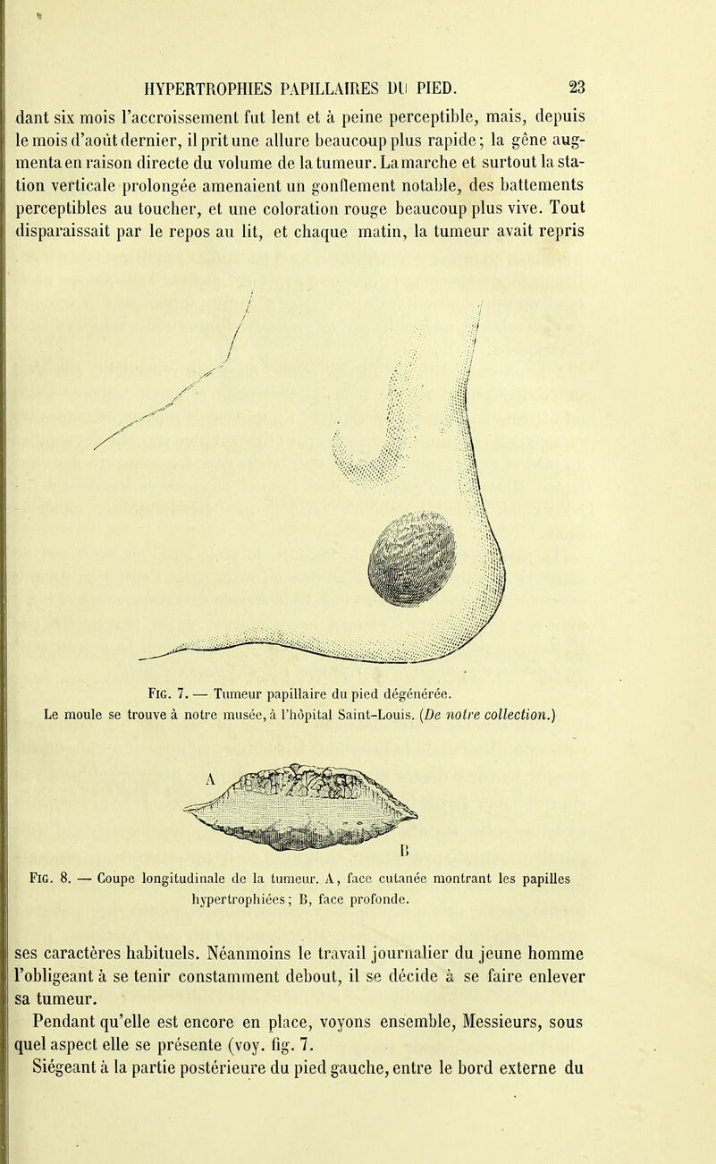 dant six mois l'accroissement fut lent et à peine perceptible, mais, depuis le mois d'août dernier, il prit une allure beaucoup plus rapide; la gène aug- menta en raison directe du volume de la tumeur. La marche et surtout la sta- tion verticale prolongée amenaient un gonflement notable, des battements perceptibles au toucher, et une coloration rouge beaucoup plus vive. Tout disparaissait par le repos au lit, et chaque matin, la tumeur avait repris /. FiG. 7. — Tumeur papillaire du pied dégénérée. Le moule se trouve à notre musée, à l'hôpital Saint-Louis. (De notre collection.) FiG. 8. — Coupe longitudinale de la tumeur. A, face cutanée montrant les papilles hypertrophiées; B, face profonde. ses caractères habituels. Néanmoins le travail journalier du jeune homme l'obligeant à se tenir constamment debout, il se décide à se faire enlever sa tumeur. Pendant qu'elle est encore en place, voyons ensemble. Messieurs, sous quel aspect elle se présente (voy. fig. 7. Siégeant à la partie postérieure du pied gauche, entre le bord externe du