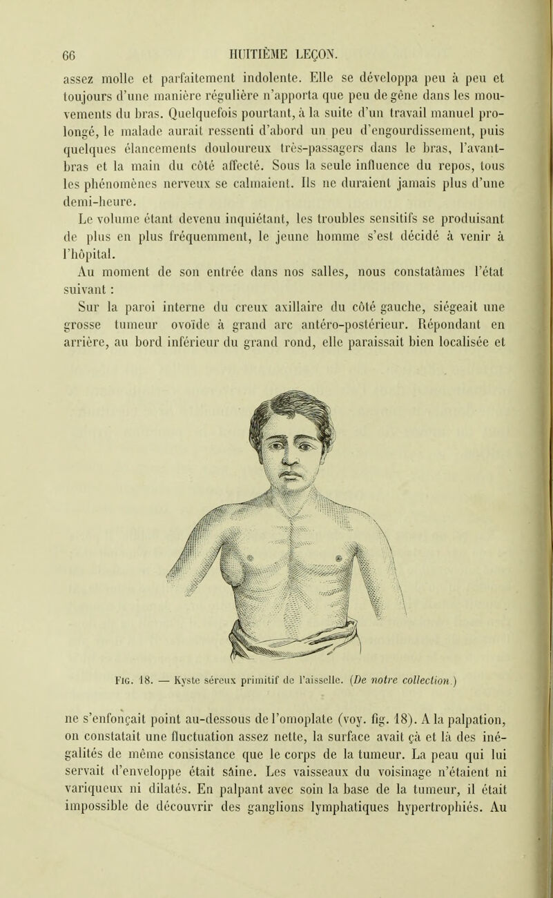 assez molle et parfaitement indolente. Elle se développa peu à peu et toujours d'une manière régulière n'apporta que peu de gêne dans les mou- vements du bras. Quelquefois pourtant, à la suite d'un travail manuel pro- longé, le malade aurait ressenti d'abord un peu d'engourdissement, puis quelques élancements douloureux très-passagers dans le bras, l'avant- bras et la main du côté affecté. Sous la seule influence du repos, tous les phénomènes nerveux se calmaient. Ils ne duraient jamais plus d'une demi-heure. Le volume étant devenu inquiétant, les troubles sensitifs se produisant de plus en plus fréquemment, le jeune homme s'est décidé à venir à l'hôpital. Au moment de son entrée dans nos salles, nous constatâmes l'état suivant : Sur la paroi interne du creux axillaire du côté gauche, siégeait une grosse tumeur ovoïde à grand arc antéro-postérieur. Répondant en arrière, au bord inférieur du grand rond, elle paraissait bien localisée et FiG. 18. — Kyste séreux primitil' de l'aisselle. (De notre coUeclion.) ne s'enfonçait point au-dessous de l'omoplate (voy. fig. 18). A la palpation, on constatait une fluctuation assez nette, la surface avait çà et là des iné- galités de même consistance que le corps de la tumeur. La peau qui lui servait d'enveloppe était sàine. Les vaisseaux du voisinage n'étaient ni variqueux ni dilatés. En palpant avec soin la base de la tumeur, il était impossible de découvrir des ganglions lymphatiques hypertrophiés. Au