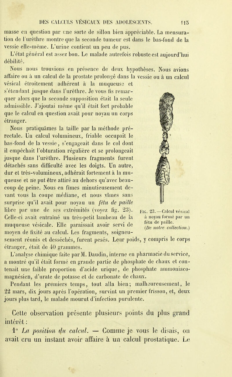 niasse en question par i;ne sorte de sillon bien appréciable. La mensura- tion de l'urèthre montre que la seconde tumeur est dans le bas-fond de la vessie elle-même. L'urine contient un peu de pus. L'état général est assez bon. Le malade autrefois robuste est aujourd'hui débilité. Nous nous trouvions en présence de deux hypothèses. Nous avions affaire ou à un calcul de la prostate prolongé dans la vessie ou à un calcul vésical étroitement adhérent à la muqueuse et s'étendant jusque dans l'urèthre. Je vous fis remar- quer alors que la seconde supposition était la seule admissible. J'ajoutai même qu'il était fort probable que le calcul en question avait pour noyau un corps étranger. Nous pratiquâmes la taille par la méthode pré- rectale. Un calcul volumineux, friable occupait le bas-fond de la vessie, s'engageait dans le col dont il empêchait l'obturation régulière et se prolongeait jusque dans l'urèthre. Plusieurs fragments furent détachés sans difficulté avec les doigts. Un autre, dur et très-volumineux, adhérait fortement à la mu- queuse et ne put être attiré au dehors qu'avec beau- coup dç peine. Nous en fîmes minutieusement de- vant vous la coupe médiane, et nous vîmes sans surprise qu'il avait pour noyau un fétu de paille libre par une de ses extrémités (voyez fig. 23). Celle-ci avait entraîné un très-petit lambeau de la muqueuse vésicale. Elle paraissait avoir servi de moyen de fixité au calcul. Les fragments, soigneu- sement réunis et desséchés, furent pesés. Leur poids, y compris le corps étranger, était de iO grammes. L'analyse chimique faite par M. Daudin, interne en pharmacie du service, a montré qu'il était formé en grande partie de phosphate de chaux et con- tenait une faible proportion d'acide urique, de phosphate annnoniaco- magnésien, d'urate de potasse et dt carbonate de chaux. Pendant les premiers temps, tout alla bien; malhaureusement, le 22 mars, dix jours après l'opération, survint un premier frisson, et, deux jours plus tard, le malade mourut d'infection purulente. Fio. 23. —Calcul vésical à noyau formé par un fétu de paille. (De notre collection.) Cette observation présente plusieurs points du plus grand intérêt : 1 La position 4u calcul. — Comme je vous le disais, on avait cru un instant avoir affaire à un calcul prostatique. Le <