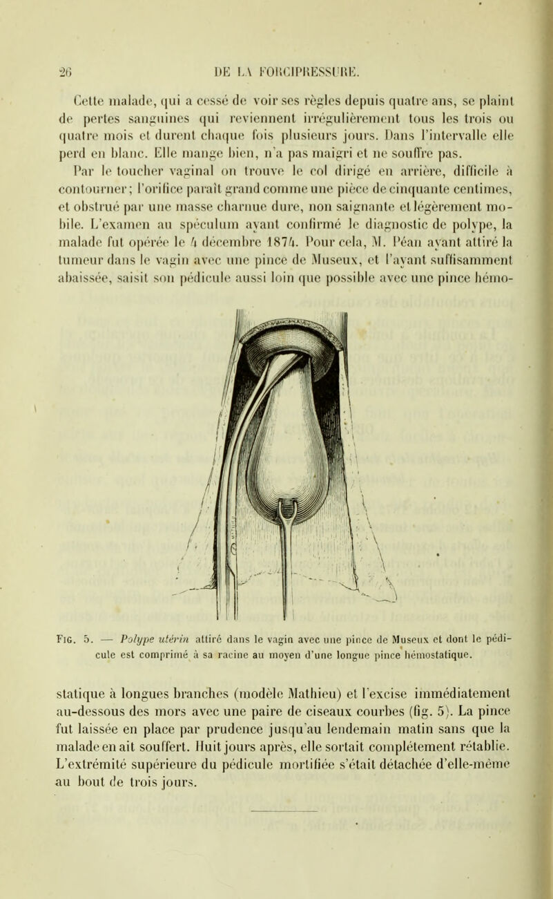 -26 1)1-: I.A l'OI{CIPUESSli|5lv Cette malade, qui a cessé do voir ses règles depuis quatre ans, se plaint de pertes saufiuiiies (jui reviennent irrégulièrement tous les trois ou quatre mois et durent cha(|ue Ibis plusieurs jours. Dans l'intervalle elle perd en blanc. Elle niaiig(^ hien, na pas maigri et ne soulTre pas. Par le toucher vaginal on trouve le col dirigé en arrière, diflicile à contourner; l'orilice parait grand comme une pièce de cinquante centimes, et obstrué par une masse charnue dure, non saiguante et légèrement mo- bile. L'examen au spéculum ayant conlirmé le diagnostic de polype, la malade fut opérée le fi décembre 187/i. Pour cela, M. Péan ayant attiré la tumeur dans le vagin avec une pince de Museux, et l'ayant sul'lisamment abaissée, saisit son pédicule aussi loin que possible avec une pince liémo- FiG. 5. — Polype utérin attiré dans le vagin avec une pince de Museiix et dont le pédi- cule est comprimé à sa racine au moyen d'une longue pince hémostatique. statique à longues branches (modèle Mathieu) et l'excise immédiatement au-dessous des moi's avec une paire de ciseaux courbes (fig. 5). La pince fut laissée en place par prudence jusqu'au lendemain matin sans que la maladeenait souffert. Huit jours après, elle sortait complètement rétablie. L'extrémité supérieure du pédicule mortifiée s'était détachée d'elle-même au bout (!e trois jours.