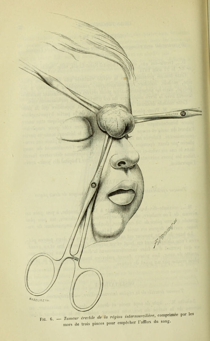 F,c G - Tumeur érectUe de la région intersourciUère, comprimée par les mors de trois pinces pour empêcher l'afflux du sang.