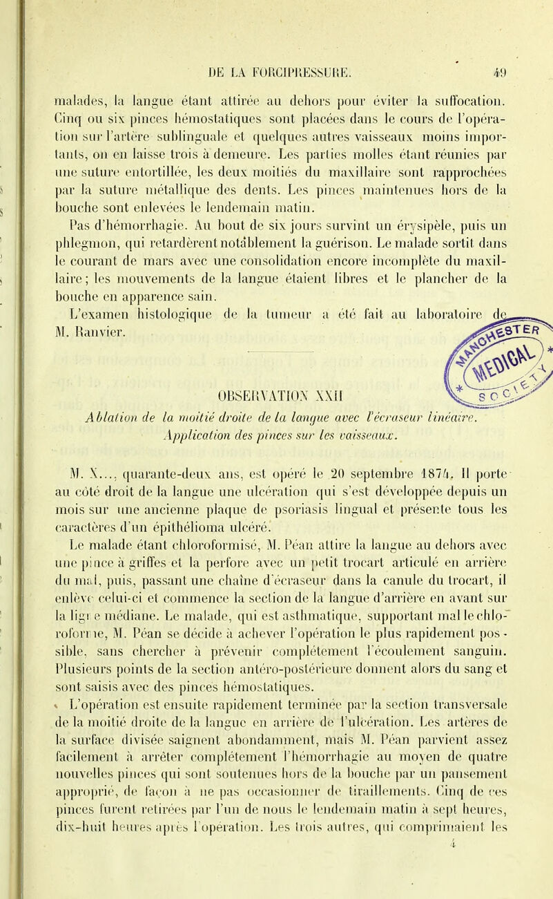 malades, la langue étant attirée au dehors pour éviter la suiïocation. Cinq ou six ])inces liémostatiques sont placées dans le cours de l'opéra- tion sui'rartt'rc sublinguale et quelques autres vaisseaux moins inq)or- tanls, on en laisse trois à demeure. Les parties molles étant réunies |)ar une suture entortillée, les deux moitiés du maxillaire sont rapprochées par la suture métallique des dents. Les pinces maintenues hors de la bouche sont enlevées le lendemain matin. Pas d'hémorrhagie. Au bout de six jours survint un érysipèle, puis un phlegmon, qui retardèrent notablement la guérison. Le malade sortit dans le courant de mars avec une consolidation encore incomplète du maxil- laire ; les mouvements de la langue étaient libres et le plancher de la bouche en apparence sain. L'examen histologique de la tumeur a été fait au laboratoire d^ Ablation de la moitié droite de la langue avec l'écntscur linéaire. Application des pinces sur les vaisseaux. M. X..., quarante-deux ans, est opéré le 20 septembre 187/i. Il porte au côté droit de la langue une ulcération qui s'est développée depuis un mois sur une ancienne plaque de psoriasis lingual et présente tous les caractères d'un épithélioma ulcéré. Le malade étant cliloroformisé, M. Péan attire la langue au dehors avec une pince à griffes et la perfore avec un petit trocart articulé en arrière du mal, puis, passant une chaîne d écraseur dans la canule du trocart, il enlève celui-ci et commence la section de la langue d'arrière en avant sur la ligr e médiane. Le malade, qui est asthmatique, su})portant mal lechlo- rolbrne, M. Péan se décide à achever l'opération le plus rapidement pos - sible, sans chercher à prévenir complètement l'écoulement sanguin. Plusieurs points de la section antéro-postérieure donnent alors du sang et sont saisis avec des pinces hémostatiques. * L'opération est ensuite rapidement terminée par la section transversale de la moitié droite de la langue en arrière de l'ulcération. Les artères de la surface divisée saignent abondamment, mais M. Péan parvient assez facilement à arrêter complètement l'hémorrhagie au moyen de quatre nouvelles pinces qui sont souteinies hors de la bouche par un pansement approprié, de la«.;on à ne pas (tccasionner de tiraillements, (anq de ces ])inces furent retirées |)ar l'un de nous le lendemain matin à sept heures, dix-huit heures apifcs, l'opération. Les trois autres, qui compriniaient les M. Ranvier.