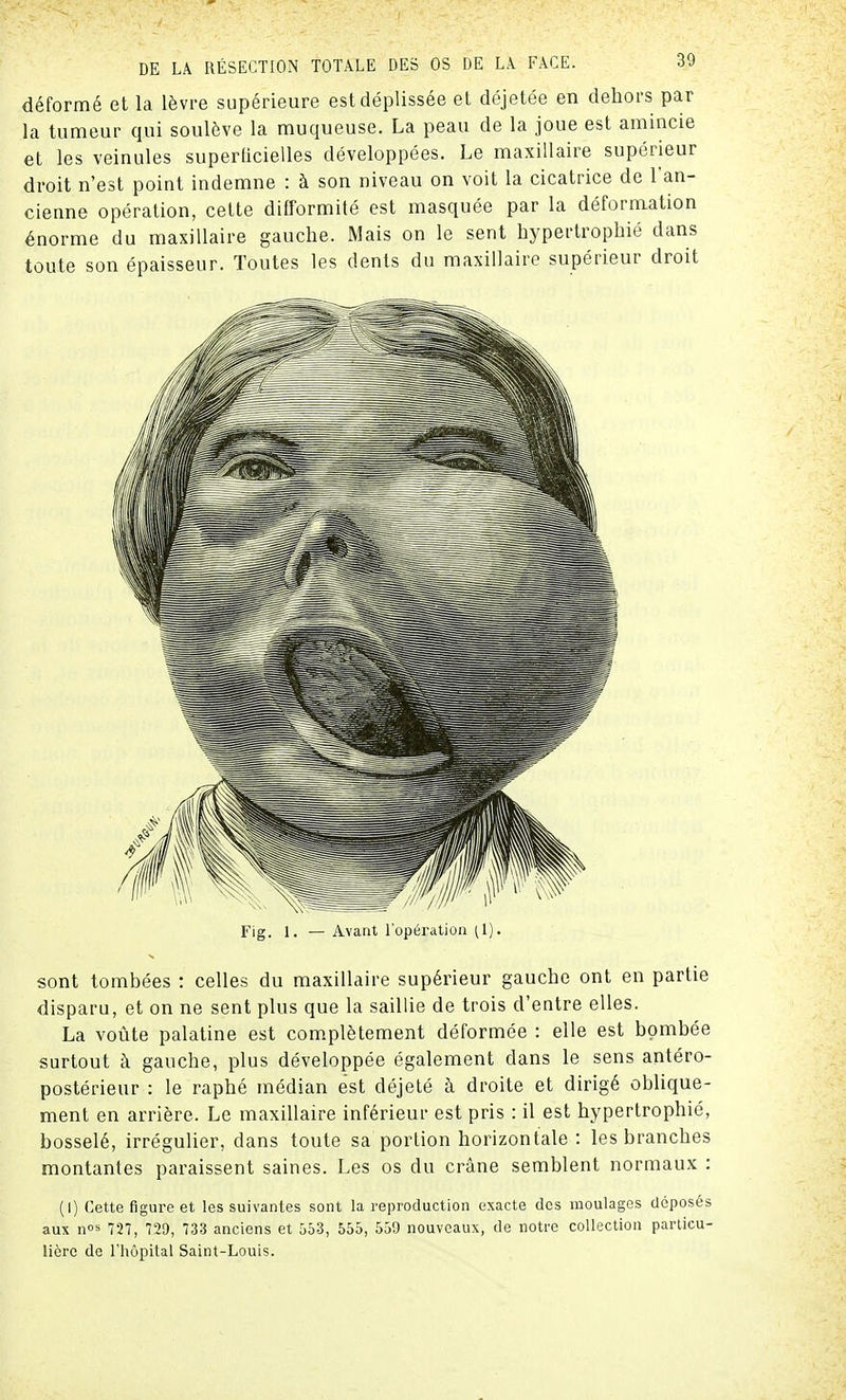 déformé et la lèvre supérieure est déplissée et déjetée en dehors par la tumeur qui soulève la muqueuse. La peau de la joue est amincie et les veinules superficielles développées. Le maxillaire supérieur droit n'est point indemne : à son niveau on voit la cicatrice de l'an- cienne opération, cette difformité est masquée par la déformation énorme du maxillaire gauche. Mais on le sent hypertrophié dans toute son épaisseur. Toutes les dents du maxillaire supérieur droit Fig. 1. — Avant l'opération (1). sont tombées : celles du maxillaire supérieur gauche ont en partie disparu, et on ne sent plus que la saillie de trois d'entre elles. La voûte palatine est complètement déformée : elle est bombée surtout à gauche, plus développée également dans le sens antéro- postérieur : le raphé médian est déjeté à droite et dirigé oblique- ment en arrière. Le maxillaire inférieur est pris : il est hypertrophié, bosselé, irrégulier, dans toute sa portion horizontale : les branches montantes paraissent saines. Les os du crâne semblent normaux : (I) Cette figure et les suivantes sont la reproduction exacte des moulages déposés aux nos 727, 729, 733 anciens et 553, 555, 559 nouveaux, de notre collection particu- lière de l'hôpital Saint-Louis.