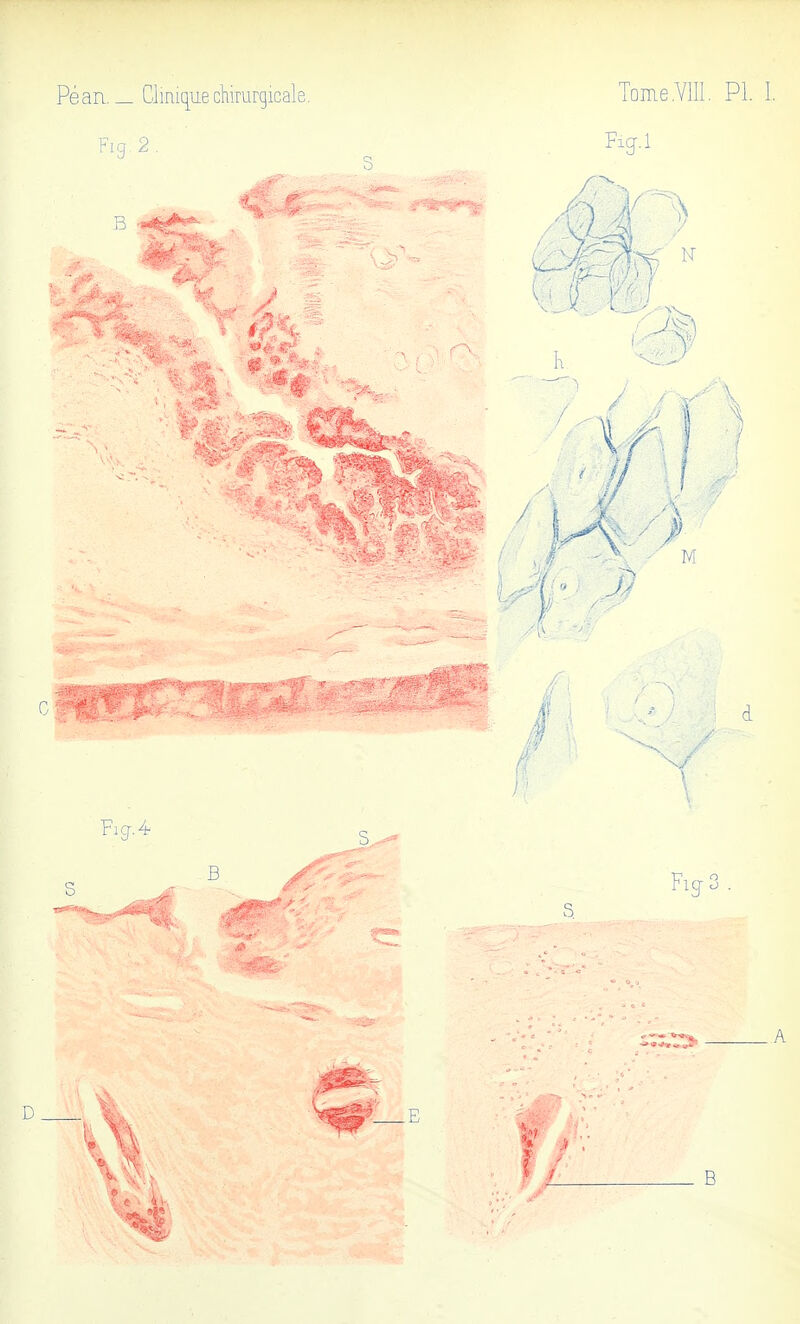 Péan. _ Clinique chirurgicale. Fig 2 . T.ffJk Tome .VIII. PI Vf? s? J) M Ficf.4- d %3,