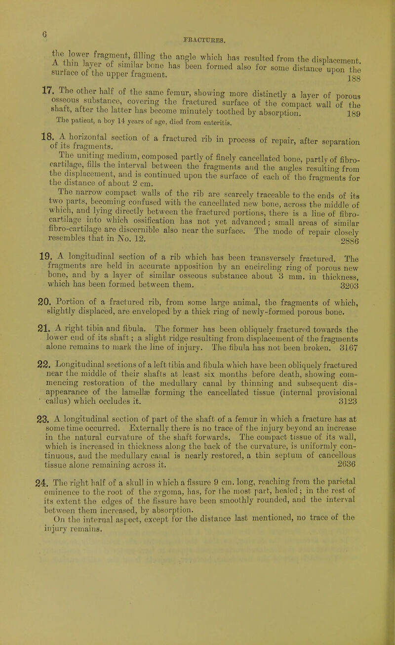 riiAOTtrnES. the lower fragment iillmg the angle whieh ha, resulted from the displacement furl^;:X°4riXS;rt.''°^^-^^^'^^^ loo 17. The other half of the same femur, showing more distinctly a layer of porous osseous substance, covering the fractured surface of the compact wail of the snatt, alter the latter has become minutely toothed by absorption. 189 The patient, a boy 14 years of age, died from enteritis. ■^^offts^fiSmints'^'^''''' fractured rib in process of repair, after separation The uniting medium, composed partly of finely cancellated bone, partly of fibro- carti age fills the mterval between the fragments and the angles resulting from the displacement, and is continued upon the surface of each of the frac^ments for the distance of about 2 cm. ° The narrow compact walls of the rib are scarcely traceable to the ends of its two parts, becoming confused with the cancellated new bone, across the middle of which, and lying directly between the fractured portions, there is a line of tibro- cartilage into which ossification has not yet advanced; small areas of similar hbro-cartilage are discernible also near the surface. The mode of repair closely resembles that in No. 12. 2886 19. A longitudinal section of a rib which has been transversely fractured. The fragments are held in accurate apposition by an encircling ring of porous new bone, and by a layer of similar osseous substance about 3 mm. in thickness, which has been formed between them. 3203 20. Portion of a fractured rib, from some large animal, the fragments of which, slightly displaced, are enveloped by a thick ring of newly-formed porous bone. 21. A right tibia and fibula. The former has been obliquely fractured towards the low er end of its shaft; a slight ridge resulting from displacement of the fragments alone remains to mark the line of injury. The fibula has not been broken. 3167 22. Longitudinal sections of a left tibia and fibula which have been obliquely fractured near the middle of their shafts at least six months before death, showing com- mencing restoration of the medullary canal by thinning and subsequent dis- appearance of the lamellae forming the cancellated tissue (internal provisional ■ callus) which occludes it. 3123 23. A longitudinal section of part of the shaft of a femur in which a fracture has at some time occurred. Extei-nally there is no trace of the injury beyond an increase in the natural curvature of the shaft forwards. The compact tissue of its wall, which is increased in thickness along the back of the curvature, is uniformly con- tinuous, and the medullary canal is nearly restored, a thin septum of cancellous tissue alone remaining across it. 2636 24. The right half of a skull in which a fissure 9 cm. long, reaching from the parietal eminence to the root of the Kvgoma, has, for the most part, healed; in the rest of its extent the edges of the fissure have been smoothly rounded, and the interval between them increased, by absorption. On the internal aspect, except for the distance last mentioned, no trace of the injury remains.