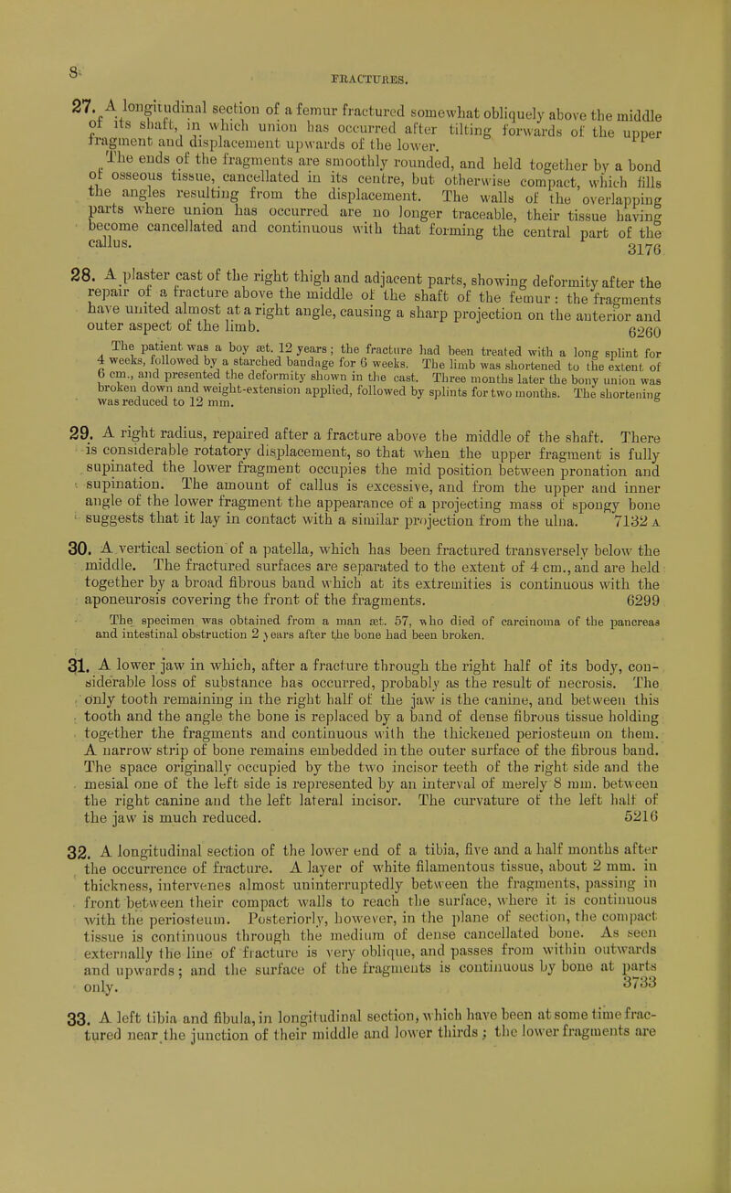 8^ PRACTURES. 27. A loiigiiudmal section of a femur fractured somewhat obliquely above the middle ot Its sliatt in which union has occurred after tilting forwards of the upper fragment and displacement upwards of the lower. The ends of the fragments are smoothly rounded, and held together by a bond ot osseous tissue, cancellated in its centre, but otherwise compact, which fills the angjes resulting from the displacement. The walls of the overlapping parts where union has occurred are no longer traceable, their tissue having become cancellated and continuous with that forming the central part of the callus. gj^yg 28. A plaster cast of the right thigh and adjacent parts, showing deformity after the repair of a fracture above the middle of the shaft of the femur : the fragments have united almost at a right angle, causing a sharp projection on the anterior and outer aspect of the limb. g2gQ The patient was a boy at. 12 years; the fracture liad been treated with a long splint for 4 weeks, followed by a starched bandage for 6 weeks. The limb was shortened to the extent of b em., and presented the deformity shown in the cast. Three months later the bony union was broken down and weight-extension applied, followed by splints for two months. The shortening was reduced to 12 mm. ° 29. A right radius, repaired after a fracture above the middle of the shaft. There is considerable rotatory displacement, so that when the upper fragment is fully snpinated the lower fragment occupies the mid position between pronation and supination. The amount of callus is excessive, and from the upper and inner angle of the lower fragment the appearance of a projecting mass of spongy bone ' suggests that it lay in contact with a similar projection from the ulna. 7132 a 30. A vertical section of a patella, which has been fractured transversely below- the middle. The fractured surfaces are separated to the extent of 4 cm., and are held together by a broad fibrous baud which at its extremities is continuous with the aponeurosis covering the front of the fragments, 6299 The specimen was obtained from a man set. 57, ■vsho died of carcinoma of the pancreas and intestinal obstruction 2 j ears after the bone bad been broken. 31. A lower jaw in which, after a fracture through the right half of its body, con- siderable loss of substance has occurred, probably as the result of necrosis. The only tooth remaining in the right half of the jaw is the canine, and between this . tooth and the angle the bone is replaced by a band of dense fibrous tissue holding together the fragments and continuous with the thickened periosteum on them. A narrow strip of bone remains embedded in the outer surface of the fibrous baud. The space originally occupied by the two incisor teeth of the right side and the . mesial one of the left side is represented by an interval of merely 8 mm. between the right canine and the left lateral incisor. The cui'vature of the left half of the jaw is much reduced. 6216 32. A longitudinal section of the low-er end of a tibia, five and a half months after the occurrence of fracture. A layer of white filamentous tissue, about 2 mm. in thickness, intervenes almost uninterruptedly between the fragments, passing in front be1>ween their compact walls to reach tlie surface, where it is continuous with the periosteum. Posteriorly, however, in the plane of section, the compact tissue is continuous through the medium of dense cancellated bone. As seen externally the line of fracture is very oblique, and passes from withiu outwards and upwards; and the surface of the fragments is continuous by bone at parts only. 3733 33. A left tibia and fibula, in longitudinal section, which have been at some time frac- tured near.the junction of their middle and lower thirds ; the lower fragments are