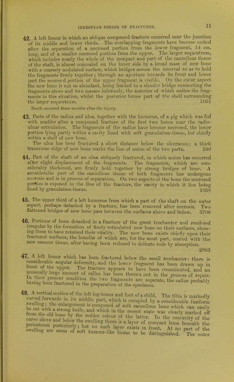 lEHBaUI.AR BBPAin OF PHACTtmiS. 42. A left femur in wliich an oblique compound fracture occurred near the junction of its middle aud lower thirds. The overlapping fragments have become united after the separation of a necrosed portion from the lower fragment, 14 cm. long, and of a smaller necrosed portion from tlie upper. The larger sequestrum, which includes nearly the whole of the compact and part of the cancellous tissue of the shaft, is almost concealed on the inner side by a broad mass of new bone with a coarsely nodulated surface, which bridges across the interval so as to hold the fragments firmly together; through an aperture towards its front and lower part the necrosed portion of the upper fraguient is visible. On the outer aspect the new bone is not so abundant, being limited to a slender bridge connecting the fragments above and two masses iuferiorly, the anterior of which unites the frag- ments in tliis situation, whilst the posterior forms part of the shell surrounding the larger sequestrum. 1051 Death occurred (shree months after the injury. 43. Parts of the radius and ulna, together with the humerus, of a pig wbicb was fed ■with madder after a compound fracture of the first two bones near the radio- ulnar articulation. The fragments of the radius have become necrosed, the lower portion lying partly within a cavity lined with soft granulation-tissue, but chiefly within a shell of new bone. The ulna has been fractured a short distance below the olecranon; a thick transverse ridge of new bone marks the line of union of the two parts. 240 44. Part of the shaft of an ulna obliquely fractured, in which union has occurred after slight displacement of the fragments. The fragments, which are con- siderably thickened, are firmly held together by strong bridges of bone. A considerable part of the cancellous tissue of both fragments has undergone iiocTosis and is in process of separation. On two aspects of the bone the necrosed portion is exposed in the line of the fracture, the cavity in which it lies being lined by granulation-tissue. 1058 45. The upper third of a left humerus from which a part of the shaft on the outer aspect, perhaps detached by a fracture, has been removed after necrosis. Two flattened bridges of new bone pass between the surfaces above and below. 3706 46. Portions of bone detached in a fracture of the great trochanter and rendered irregular by the formation of finely reticulated new bone on their surfaces, show- ing them to have retained their vitality. The new bone exists chiefly upon their fractured surfaces, the lamellas of which are, for the most part, coated with the new osseous tissue, after having been reduced to delicate rods by absorption. 2893 47. A left femur which has been fractured below the small trochanter: there is considerable angular deformity, aud the low. r fragment has been drawn up in trout of the upper. The fracture appears to have been comminuted, and an unusually large amount of callus has been thrown out in the process of repair hLw Lrr^'f'^''I'^-^^^^.u ^^'^ fragments are separate, the callus probabh having been fractiu-ed in the preparation of the specimen. 48. A vertical section of the left leg-bones and foot of a child. The tibia is markedly P^^' .^^^^ - consider^abTelsfform spelling the enlargerae_nt IS composed of soft cancellous bone which can easily h^Tt^'^A^^^^^^^ «^-te was clearly marked off trom the old bone by the redder colour of the latter. In the concavity of the zi:£z I'teitr'? r^^ ''.T 'y^^--p-^ S • periosteum posteriorly; but no such layer exists in front. At no nart of thn swelhng are areas of soft tumour-like ti.sue to be distingu^her ^ The outer