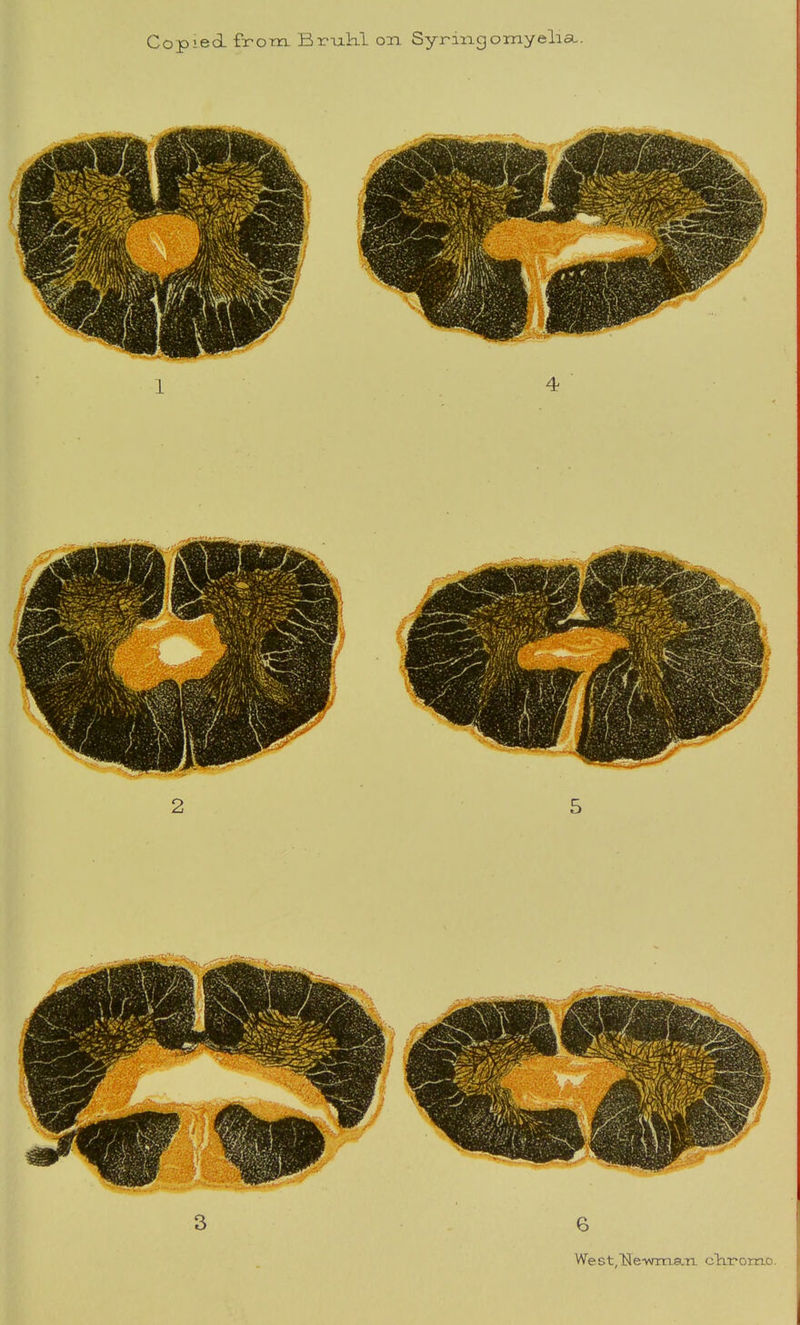 Copied from Brukl on Syringomyelia.. 6 We st( N1 e-wrn.a.n. cliromo