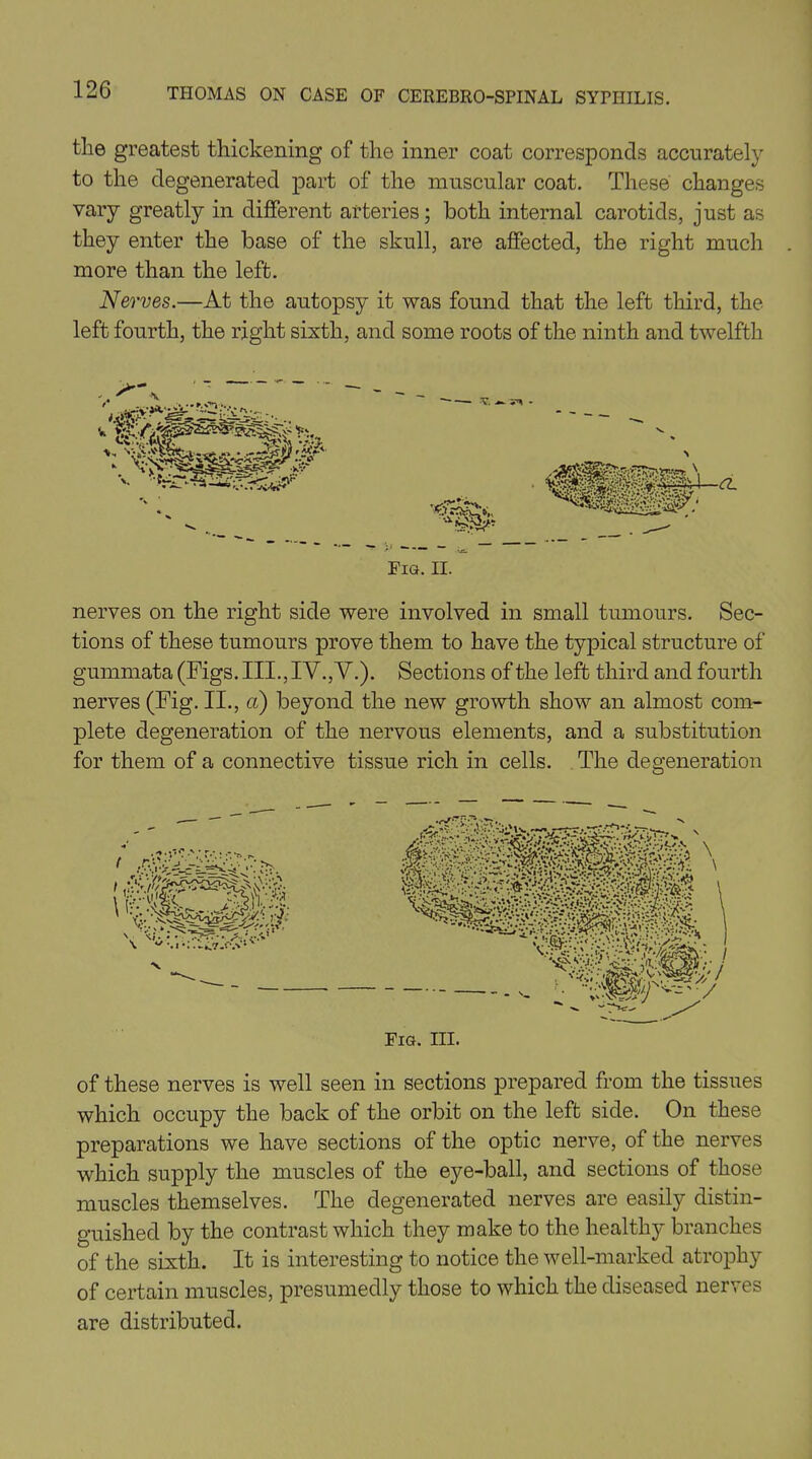 the greatest thickening of the inner coat corresponds accurately to the degenerated part of the muscular coat. These changes vary greatly in different arteries; both internal carotids, just as they enter the base of the skull, are affected, the right much more than the left. Nerves.—At the autopsy it was found that the left third, the left fourth, the right sixth, and some roots of the ninth and twelfth Fig. II. nerves on the right side were involved in small tumours. Sec- tions of these tumours prove them to have the typical structure of gummata (Figs. III., IV.,'V.). Sections of the left third and fourth nerves (Fig. II., a) beyond the new growth show an almost com- plete degeneration of the nervous elements, and a substitution for them of a connective tissue rich in cells. The degeneration Fig. III. of these nerves is well seen in sections prepared from the tissues which occupy the back of the orbit on the left side. On these preparations we have sections of the optic nerve, of the nerves which supply the muscles of the eye-ball, and sections of those muscles themselves. The degenerated nerves are easily distin- guished by the contrast which they make to the healthy branches of the sixth. It is interesting to notice the well-marked atrophy of certain muscles, presumedly those to which the diseased nerves are distributed.