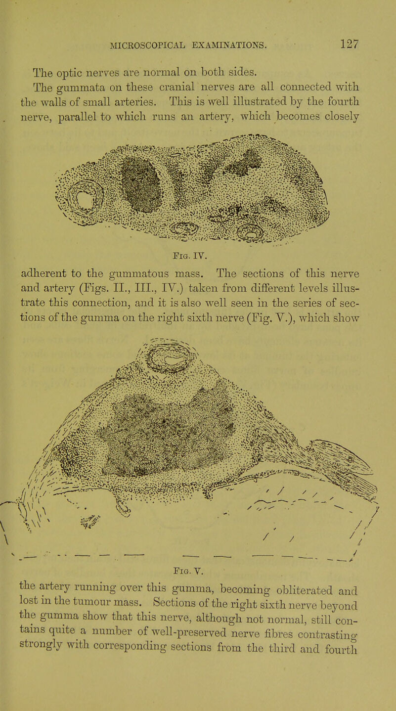 The optic nerves are normal on both sides. The gummata on these cranial nerves are all connected with the walls of small arteries. This is well illustrated by the fourth nerve, parallel to which runs an artery, which becomes closely adherent to the gummatous mass. The sections of this nerve and artery (Figs. II., III., IV.) taken from different levels illus- trate this connection, and it is also well seen in the series of sec- tions of the gumma on the right sixth nerve (Fig. V.), which show Fig. V. the artery running over this gumma, becoming obliterated and lost in the tumour mass. Sections of the right sixth nerve beyond the gumma show that this nerve, although not normal, still con- tains quite, a number of well-preserved nerve fibres contrasting strongly with corresponding sections from the third and fourth