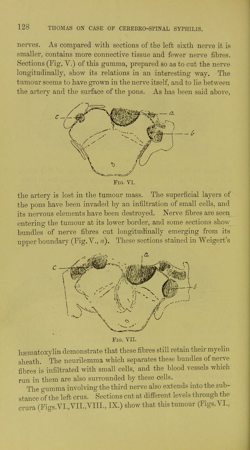 nerves. As compared with sections of the left sixth nerve it is smaller, contains more connective tissue and fewer nerve fibres. Sections (Fig. V.) of this gumma, prepared so as to cut the nerve longitudinally, show its relations in an interesting way. The tumour seems to have grown in the nerve itself, and to lie between the artery and the surface of the pons. As has been said above, the artery is lost in the tumour mass. The superficial layers of the pons have been invaded by an infiltration of small cells, and its nervous elements have been destroyed. Nerve fibres are seen entering the tumour at its lower border, and some sections show bundles of nerve fibres cut longitudinally emerging from its upper boundary (Fig. V., a). These sections stained in Weigert’s hsematoxylin demonstrate that these fibres still retain their myelin sheath. The neurilemma which separates these bundles of nerve fibres is infiltrated with small cells, and the blood vessels which run in them are also surrounded by these cells. The gumma involving the third nerve also extends into the sub- stance of the left crus. Sections cut at different levels through the crura (Figs.VI.,VIL,VIII., IN.) show that this tumour (Figs. VI.,