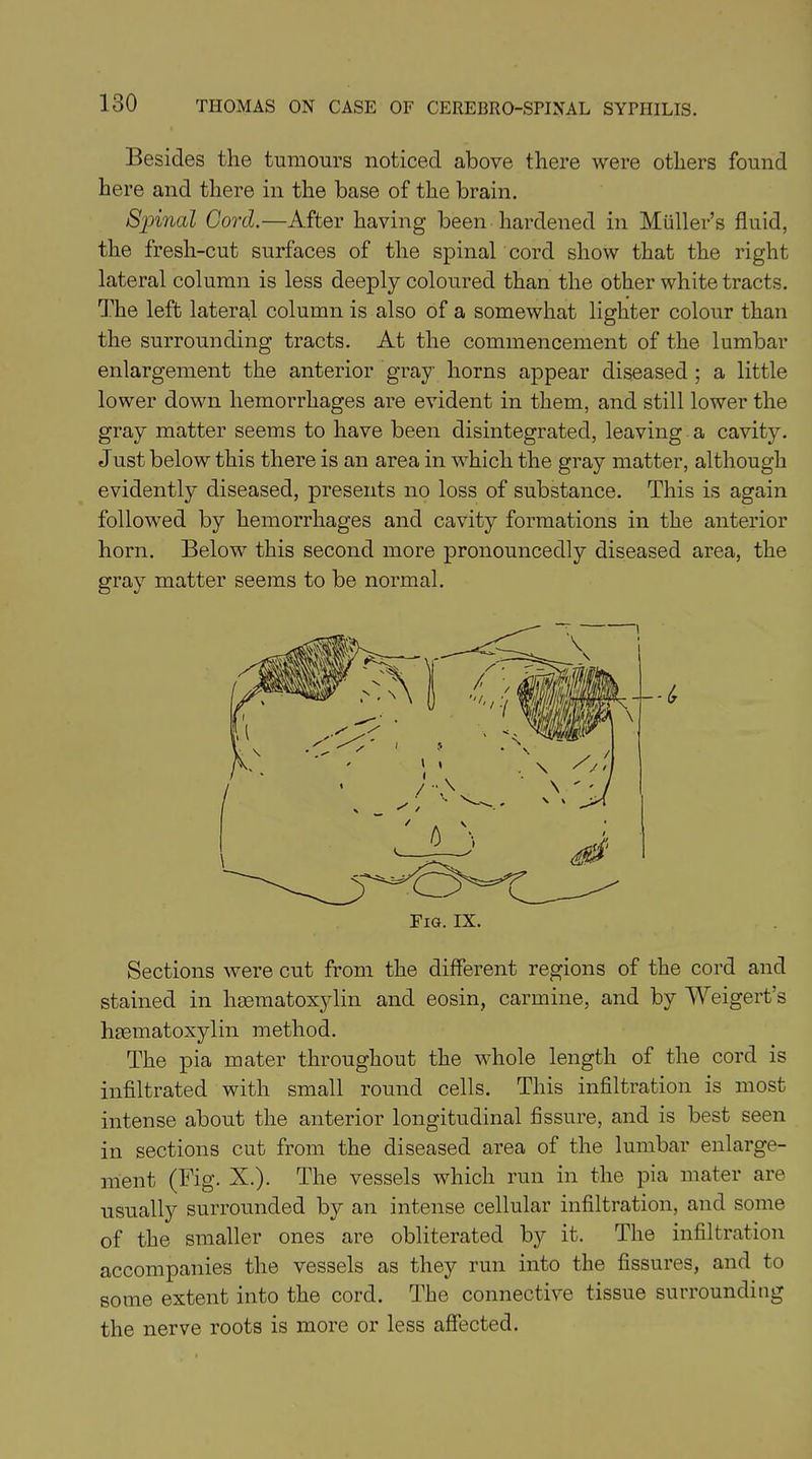 Besides the tumours noticed above there were others found here and there in the base of the brain. Spinal Cord.—After having been hardened in Muller’s fluid, the fresh-cut surfaces of the spinal cord show that the right lateral column is less deeply coloured than the other white tracts. The left lateral column is also of a somewhat lighter colour than the surrounding tracts. At the commencement of the lumbar enlargement the anterior gray horns appear diseased; a little lower down hemorrhages are evident in them, and still lower the gray matter seems to have been disintegrated, leaving a cavity. Just below this there is an area in which the gray matter, although evidently diseased, presents no loss of substance. This is again followed by hemorrhages and cavity formations in the anterior horn. BelowT this second more pronouncedly diseased area, the gray matter seems to be normal. Sections were cut from the different regions of the cord and stained in hsematoxylin and eosin, carmine, and by Weigert’s hematoxylin method. The pia mater throughout the whole length of the cord is infiltrated with small round cells. This infiltration is most intense about the anterior longitudinal fissure, and is best seen in sections cut from the diseased area of the lumbar enlarge- ment (Fig. X.). The vessels which run in the pia mater are usually surrounded by an intense cellular infiltration, and some of the smaller ones are obliterated by it. The infiltration accompanies the vessels as they run into the fissures, and to some extent into the cord. The connective tissue surrounding the nerve roots is more or less affected.