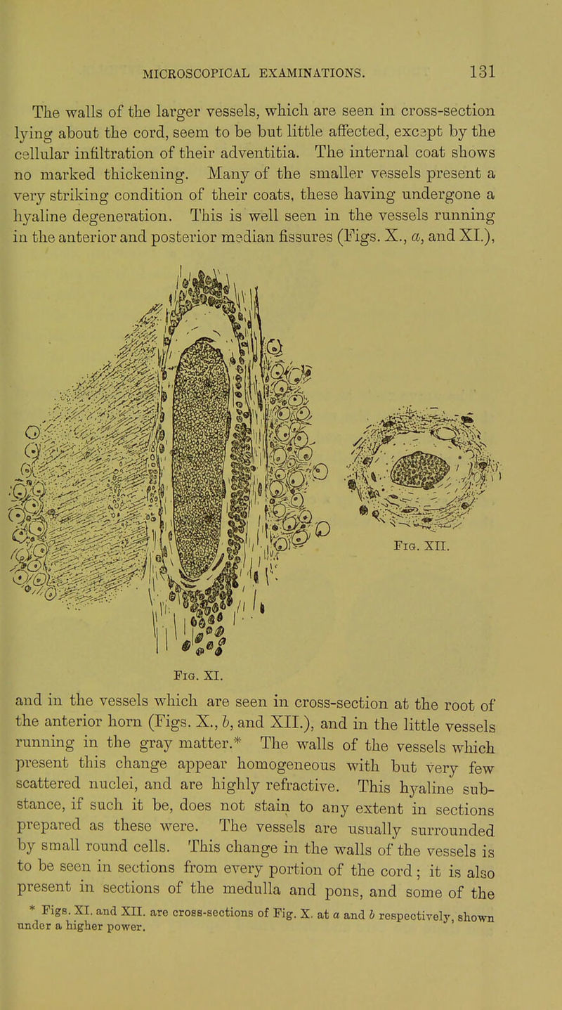 The walls of the larger vessels, which are seen in cross-section lying about the cord, seem to be but little affected, except by the cellular infiltration of their adventitia. The internal coat shows no marked thickening. Many of the smaller vessels present a very striking condition of their coats, these having undergone a hyaline degeneration. This is well seen in the vessels running in the anterior and posterior median fissures (Figs. X., a, and XI.), Fig. XI. and in the vessels which are seen in cross-section at the root of the anterior horn (Figs. X., b, and XII.), and in the little vessels running in the gray matter * The walls of the vessels which present this change appear homogeneous with but very few scattered nuclei, and are highly refractive. This hyaline sub- stance, if such it be, does not stain to any extent in sections prepaied as these were. I he vessels are usually surrounded by small round cells. This change in the walls of the vessels is to be seen in sections from every portion of the cord; it is also present in sections of the medulla and pons, and some of the * Figs. XI. and XII. are cross-sections of Fig. X. at a and b respectively shown under a higher power.