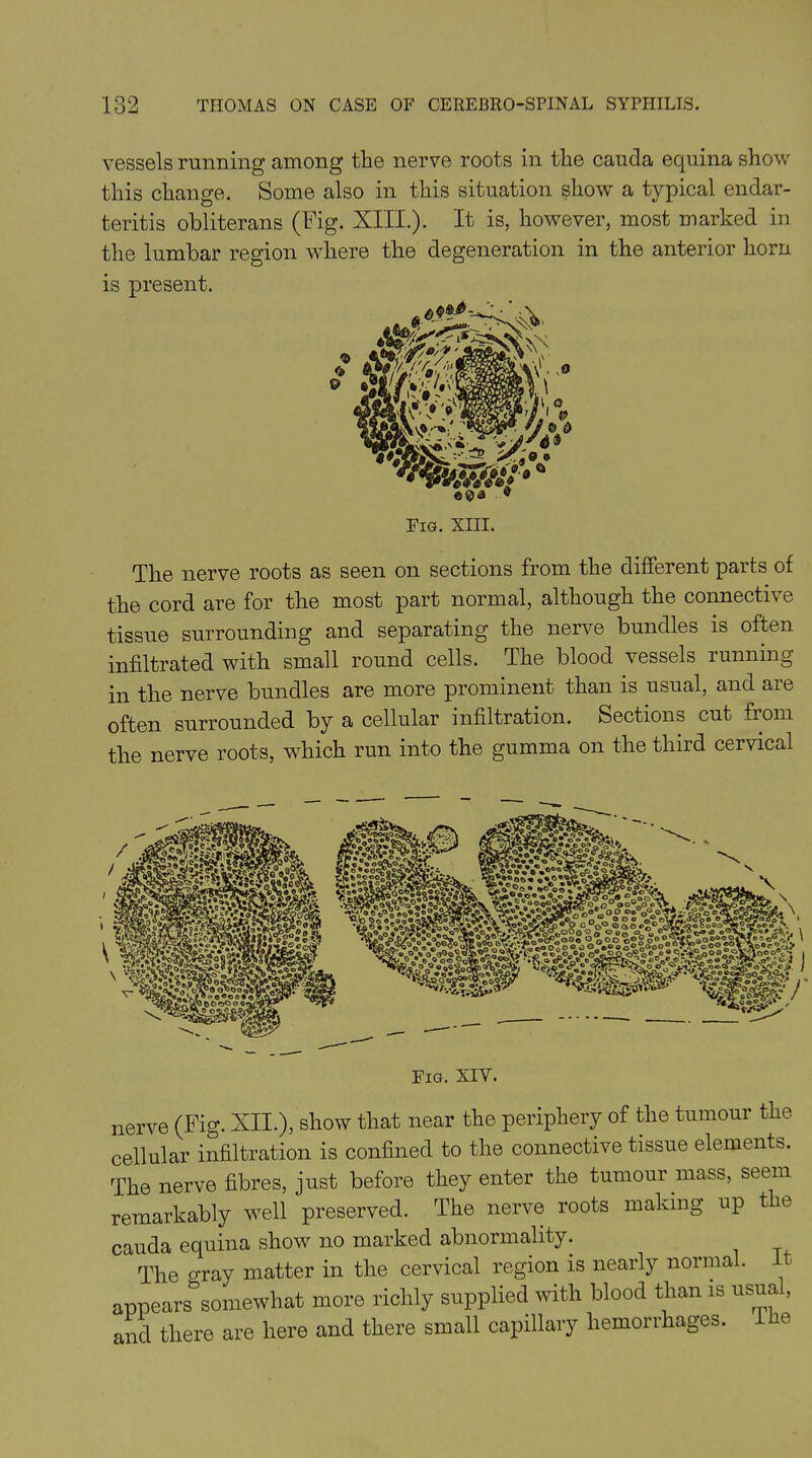 vessels running among the nerve roots in the cauda equina show this change. Some also in this situation show a typical endar- teritis obliterans (Fig. XIII.). It is, however, most marked in the lumbar region where the degeneration in the anterior horn is present. Fig. XIII. The nerve roots as seen on sections from the different parts of the cord are for the most part normal, although the connective tissue surrounding and separating the nerve bundles is often infiltrated with small round cells. The blood vessels running in the nerve bundles are more prominent than is usual, and are often surrounded by a cellular infiltration. Sections cut fiom the nerve roots, which run into the gumma on the third cervical Fig. XIY. nerve (Fig. XII.), show that near the periphery of the tumour the cellular infiltration is confined to the connective tissue elements. The nerve fibres, just before they enter the tumour mass, seem remarkably well preserved. The nerve roots making up the cauda equina show no marked abnormality. The oray matter in the cervical region is nearly norma . appears somewhat more richly supplied with blood than is usua , and there are here and there small capillary hemorrhages.