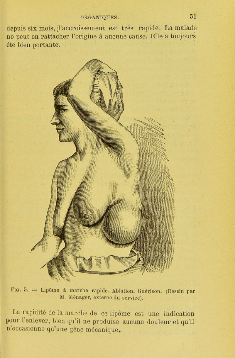 depuis six mois, iraccroissement est très rapide. La malade ne peut en rattaclier l'origine à aucune cause. Elle a toujours été bien portante. FiG. 5. — Lipôme à marche rapide. Ablation. Guérison. (Dessin par M. Ménager, exterae du service). La rapidité de la marche de ce lipôme est une indication pour l'enlever, bien qu'il ne produise aucune douleur et qu'il n'occasionne qu'une gêne mécanique.