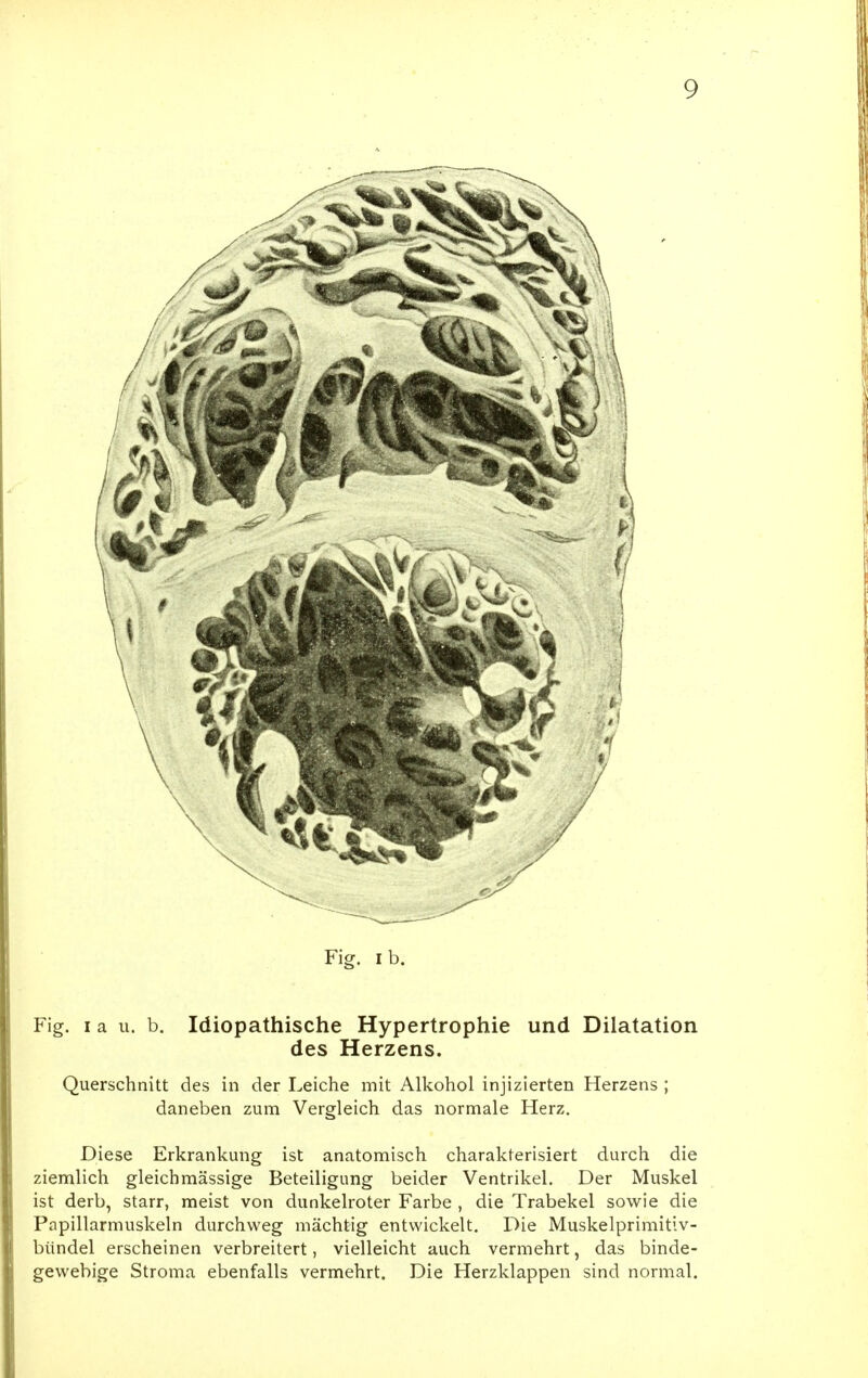 Fig. Ib. Fig. I a II. b. Idiopathische Hypertrophie und Dilatation des Herzens. Querschnitt des in der Leiche mit Alkohol injizierten Herzens ; daneben zum Vergleich das normale Herz. Diese Erkrankung ist anatomisch charakterisiert durch die ziemlich gleichmässige Beteiligung beider Ventrikel. Der Muskel ist derb, starr, meist von dunkelroter Farbe , die Trabekel sowie die Papillarmuskeln durchweg mächtig entwickelt. Die Muskelprimitiv- bündel erscheinen verbreitert, vielleicht auch vermehrt, das binde- gewebige Stroma ebenfalls vermehrt. Die Herzklappen sind normal.