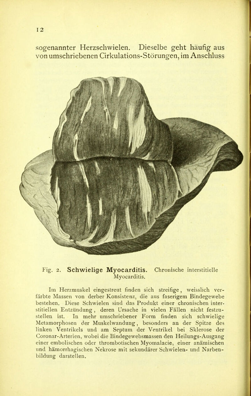 sogenannter Herzschwielen. Dieselbe geht häufig aus von umschriebenen Cirkulations-Störungen, im Anschluss Fig. 2. Schwielige Myocarditis. Chronische interstitielle Myocarditis. Im Herzmuskel eingestreut finden sich streifige, weisslich ver- färbte Massen von derber Konsistenz, die aus faserigem Bindegewebe bestehen. Diese Schwielen sind das Produkt einer chronischen inter- stitiellen Entzündung , deren Ursache in vielen Fällen nicht festzu- stellen ist. In mehr umschriebener Form finden sich schwielige Metamorphosen der Muskelwandung, besonders an der Spitze des linken Ventrikels und am Septum der Ventrikel bei Sklerose der Coronar-Arterien, wobei die Bindegewebsmassen den Heilungs-Ausgang einer embolischen oder thrombotischen Myomalacie, einer anämischen und hämorrhagischen Nekrose mit sekundärer Schwielen- und Narben- bildung darstellen.