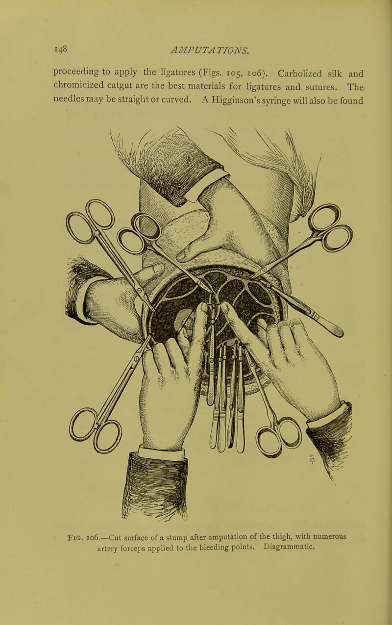 proceeding to apply the ligatures (Figs. 105, 106}. Carbolized silk and chromicized catgut are the best materials for ligatures and sutures. The needles may be straight or curved. A Higginson's syringe will also be found Fig. 106.—Cut surface of a stump after amputation of the thigh, with numerous artery forceps applied to the bleeding points. Diagrammatic.