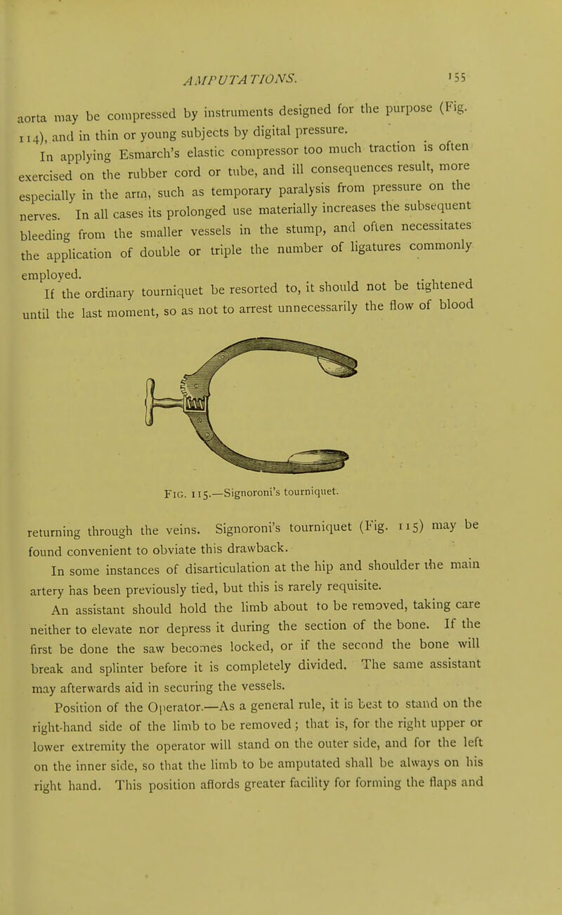 aorta may be compressed by instruments designed for tlie purpose (Fig. 114), and in thin or young subjects by digital pressure. In applying Esmarch's elastic compressor too much traction is often exercised on the rubber cord or tube, and ill consequences result, more especially in the arm, such as temporary paralysis from pressure on the nerves In all cases its prolonged use materially increases the subsequent bleedin- from the smaller vessels in the stump, and often necessitates the application of double or triple the number of ligatures commonly employed. , • , j If'the ordinary tourniquet be resorted to, it should not be tightened until the last moment, so as not to arrest unnecessarily the flow of blood Fig. 115.—Signoroni's tourniquet. returning through the veins. Signoroni's tourniquet (Fig. 115) may be found convenient to obviate this drawback. In some instances of disarticulation at the hip and shoulder ihe main artery has been previously tied, but this is rarely requisite. An assistant should hold the limb about to be removed, taking care neither to elevate nor depress it during the section of the bone. If the first be done the saw becomes locked, or if the second the bone will break and splinter before it is completely divided. The same assistant may afterwards aid in securing the vessels. Position of the Operator.—As a general rule, it is best to stand on the right-hand side of the limb to be removed; that is, for the right upper or lower extremity the operator will stand on the outer side, and for the left on the inner side, so that the limb to be amputated shall be always on his right hand. This position afiords greater facility for forming the flaps and