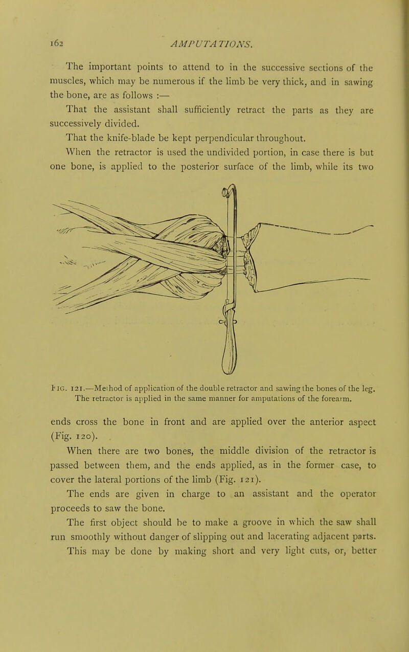 The important points to attend to in the successive sections of the muscles, which may be numerous if the limb be very thick, and in sawing the bone, are as follows :— That the assistant shall sufficiently retract the parts as they are successively divided. That the knife-blade be kept perpendicular throughout. When the retractor is used the undivided portion, in case there is but one bone, is applied to the posterior surface of the limb, while its two Jig. 121.—Method of application of the double retractor and sawing the bones of the leg. The retractor is applied in the same manner for amputations of the forearm. ends cross the bone in front and are applied over the anterior aspect (Fig. 120). When there are two bones, the middle division of the retractor is passed between them, and the ends applied, as in the former case, to cover the lateral portions of the limb (Fig. 121). The ends are given in charge to an assistant and the operator proceeds to saw the bone. The first object should be to make a groove in which the saw shall run smoothly without danger of slipping out and lacerating adjacent parts. This may be done by making short and very light cuts, or, better