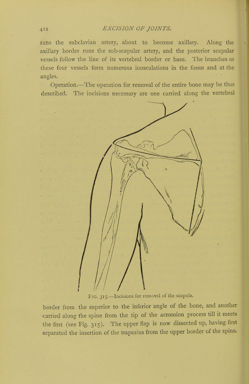 runs the subclavian artery, about to become axillary. Along the axillary border runs the sub-scapular artery, and the posterior scapular vessels follow the line of its vertebral border or base. The branches oi these four vessels form numerous inosculations in the fossae and at the angles. Operation.—The operation for removal of the entire bone may be thus described. The incisions necessary are one carried along the vertebral Fig. 315.—Incisions for removal of ilie scapula. border from the superior to the inferior angle of the bone, and another carried along the spine from the tip of the acromion process till it meets the first (see Fig. 315). The upper flap is now dissected up, having first separated the insertion of the trapezius from the upper border of the spme.